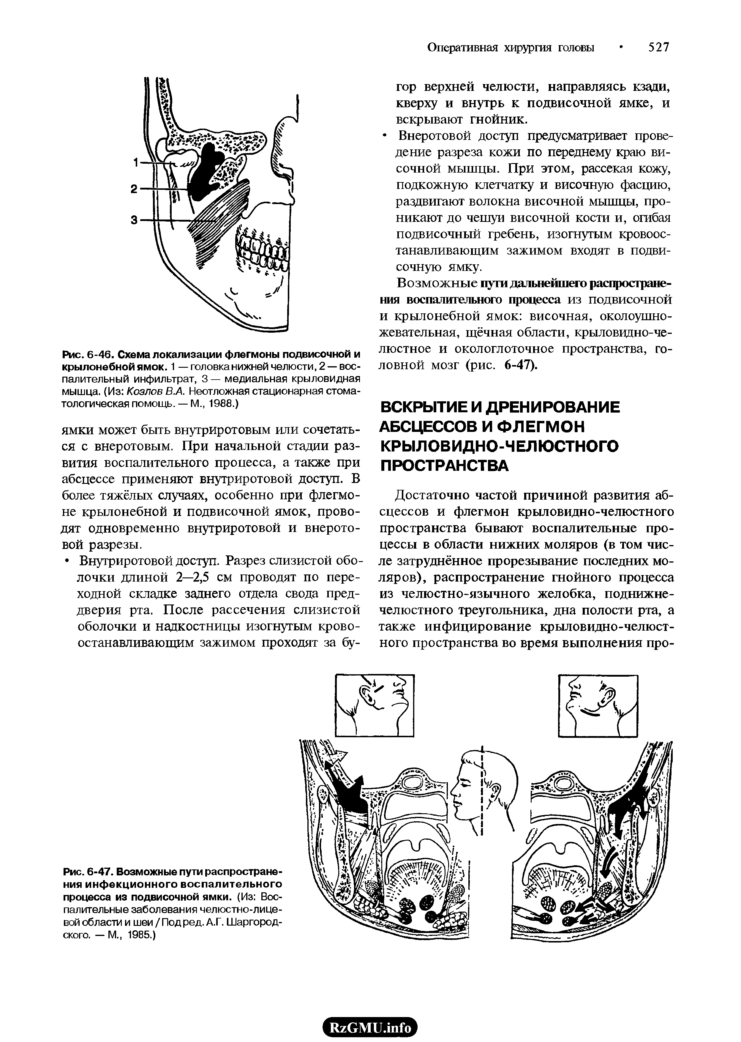 Рис. 6-46. Схема локализации флегмоны подвисочной и крылонебной ямок. 1 — головка нижней челюсти, 2 — воспалительный инфильтрат, 3 — медиальная крыловидная мышца. (Из Козлов В.А. Неотложная стационарная стоматологическая помощь. — М., 1988.)...
