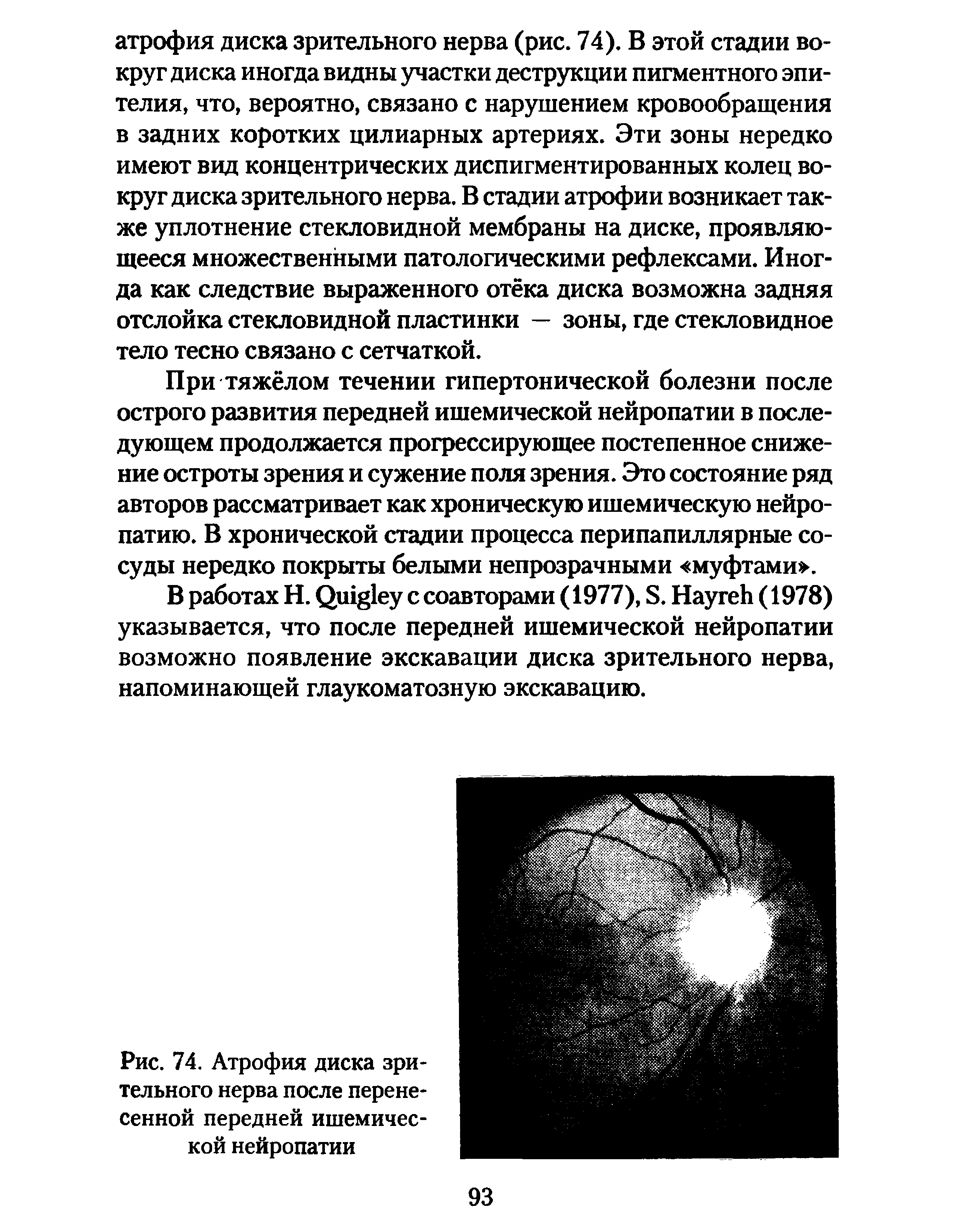 Рис. 74. Атрофия диска зрительного нерва после перенесенной передней ишемической нейропатии...