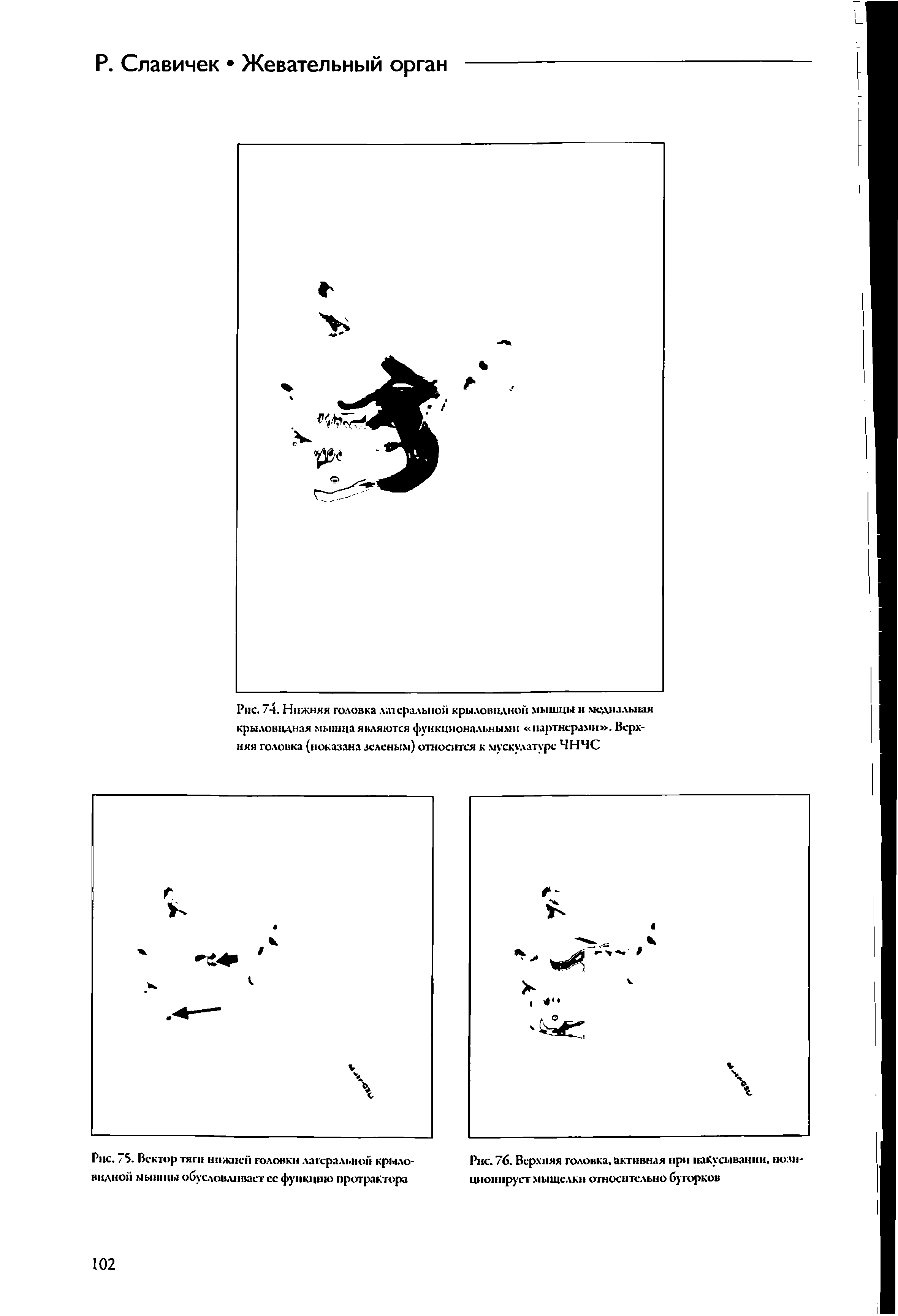 Рис. / 5. Вектор тяги нижней головки латеральной крыловидной мышцы обусловливает ее функцию протрактора...