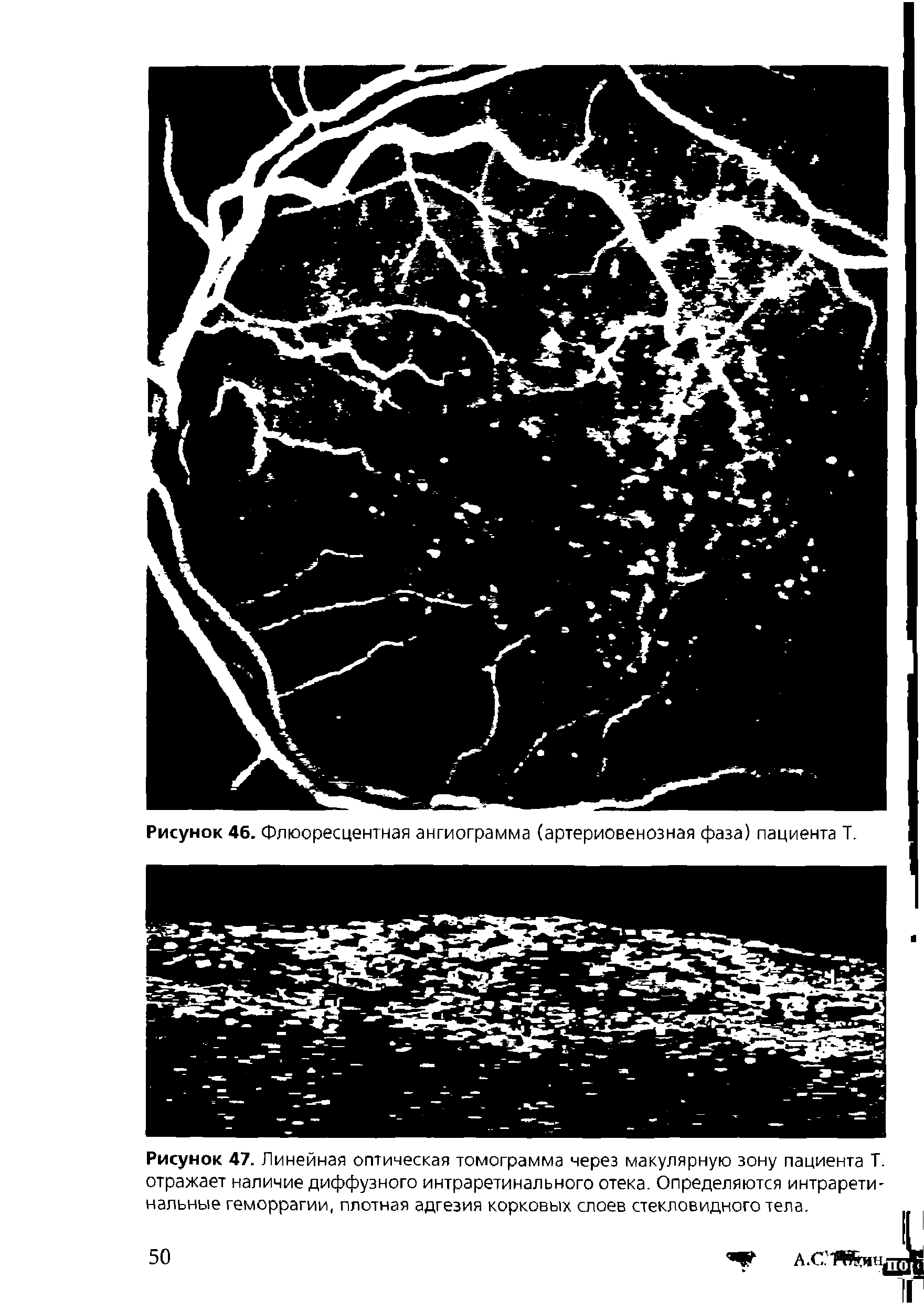 Рисунок 47. Линейная оптическая томограмма через макулярную зону пациента Т. отражает наличие диффузного интраретинального отека. Определяются интрарети-нальные геморрагии, плотная адгезия корковых слоев стекловидного тела.