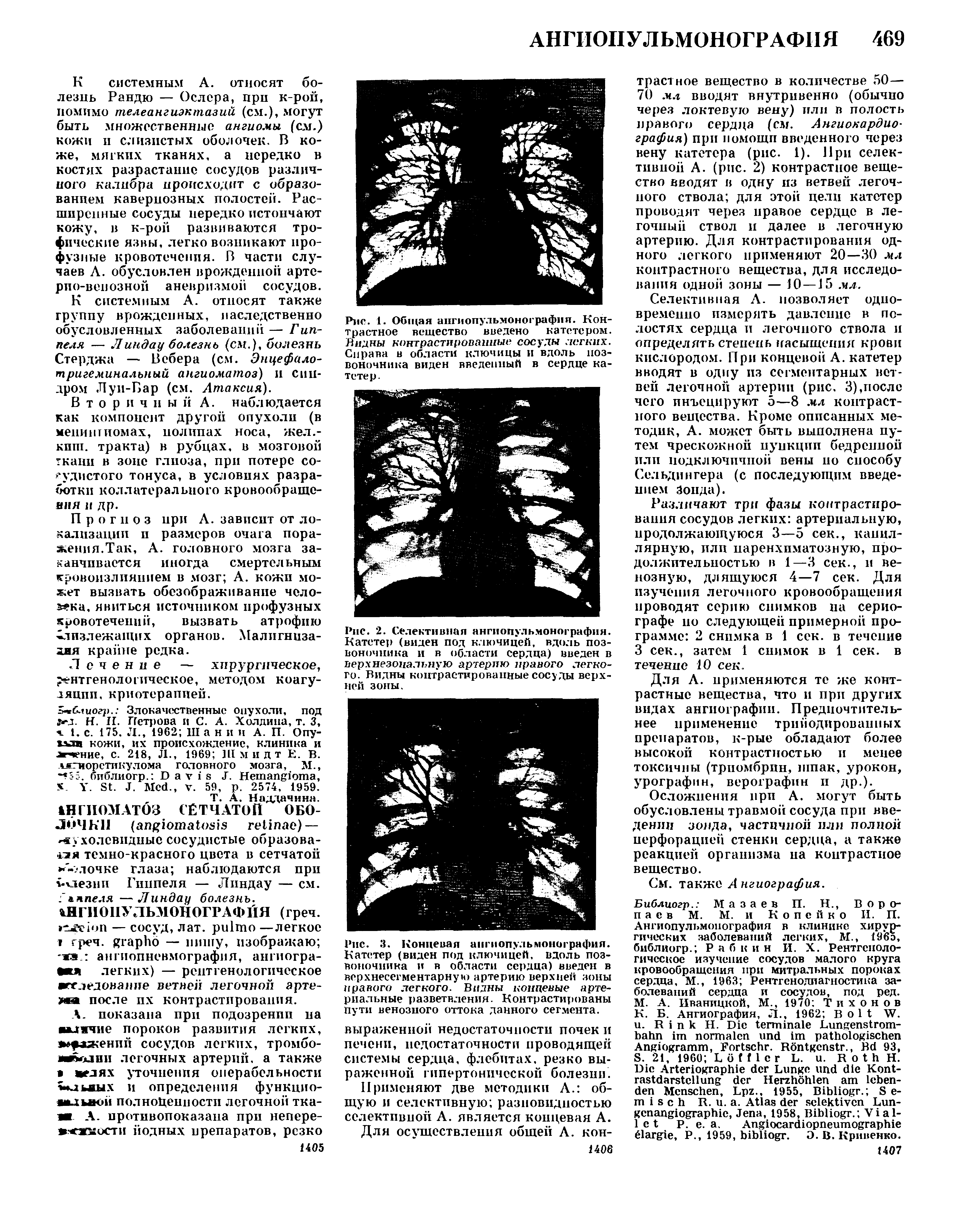 Рис. 1. Общая апгнопульмонографня. Контрастное вещество введено катетером. Видны контрастированные сосуды легких. Справа в области ключицы и вдоль позвоночника виден введенный в сердце катетер.