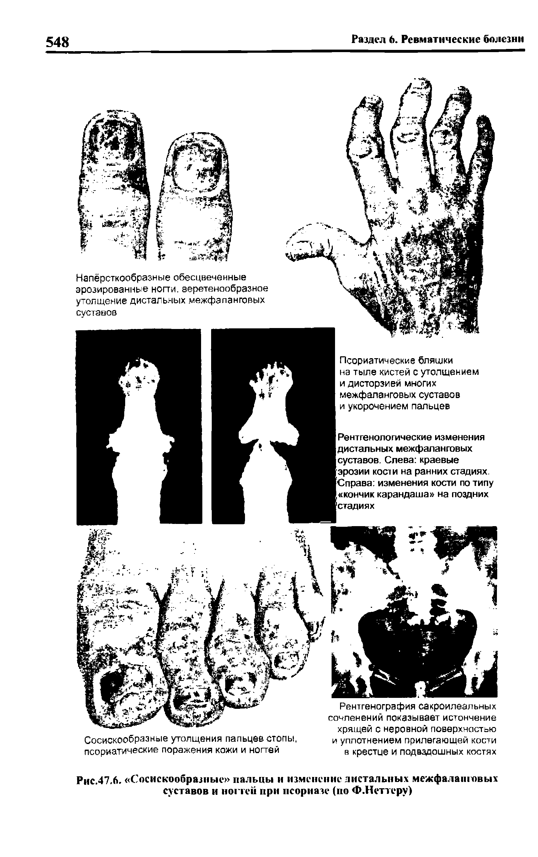 Рис.47.6. Сосискообразные пальцы и изменение апетальных межфалашовых суставов и ногтей при псориазе (по Ф.Неттеру)...