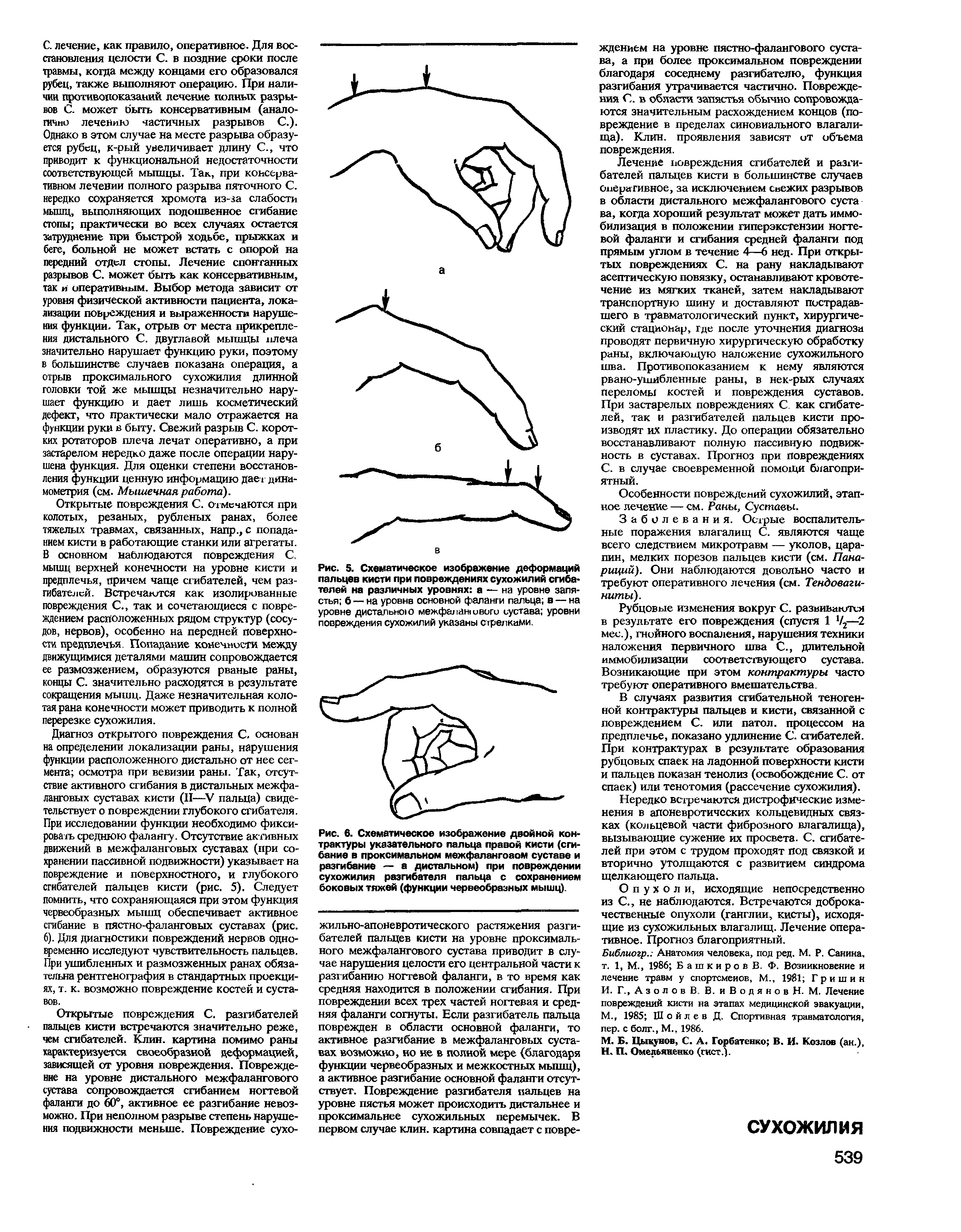 Рис. 6. Схематическое изображение двойной контрактуры указательного пальца правой кисти (сгибание в проксимальном межфалангоаом суставе и разгибание — а дистальном) при повреждении сухожилия разгибателя пальца с сохранением боковых тяжей (функции червеобразных мышц).