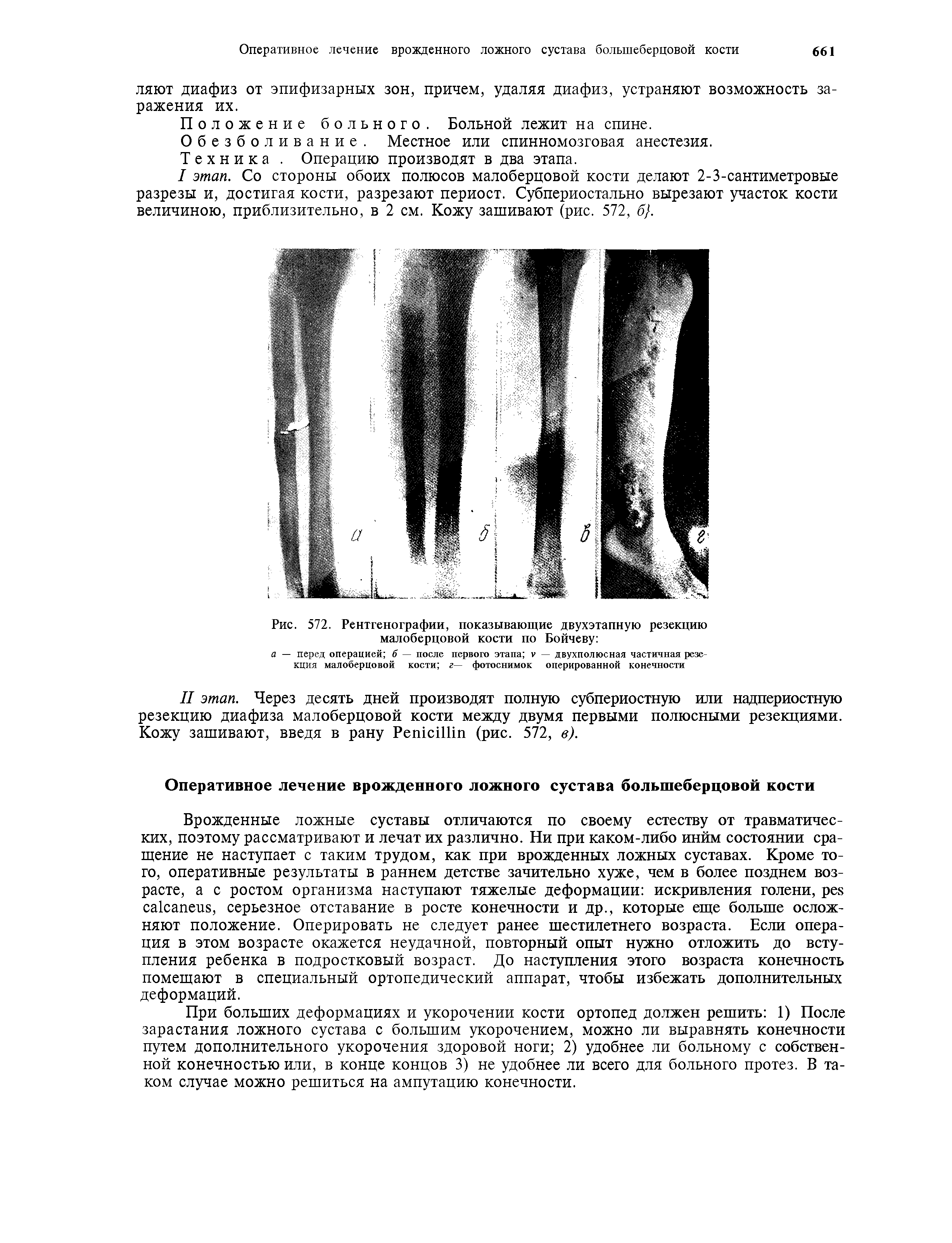 Рис. 572. Рентгенографии, показывающие двухэтапную резекцию малоберцовой кости по Бойчеву ...