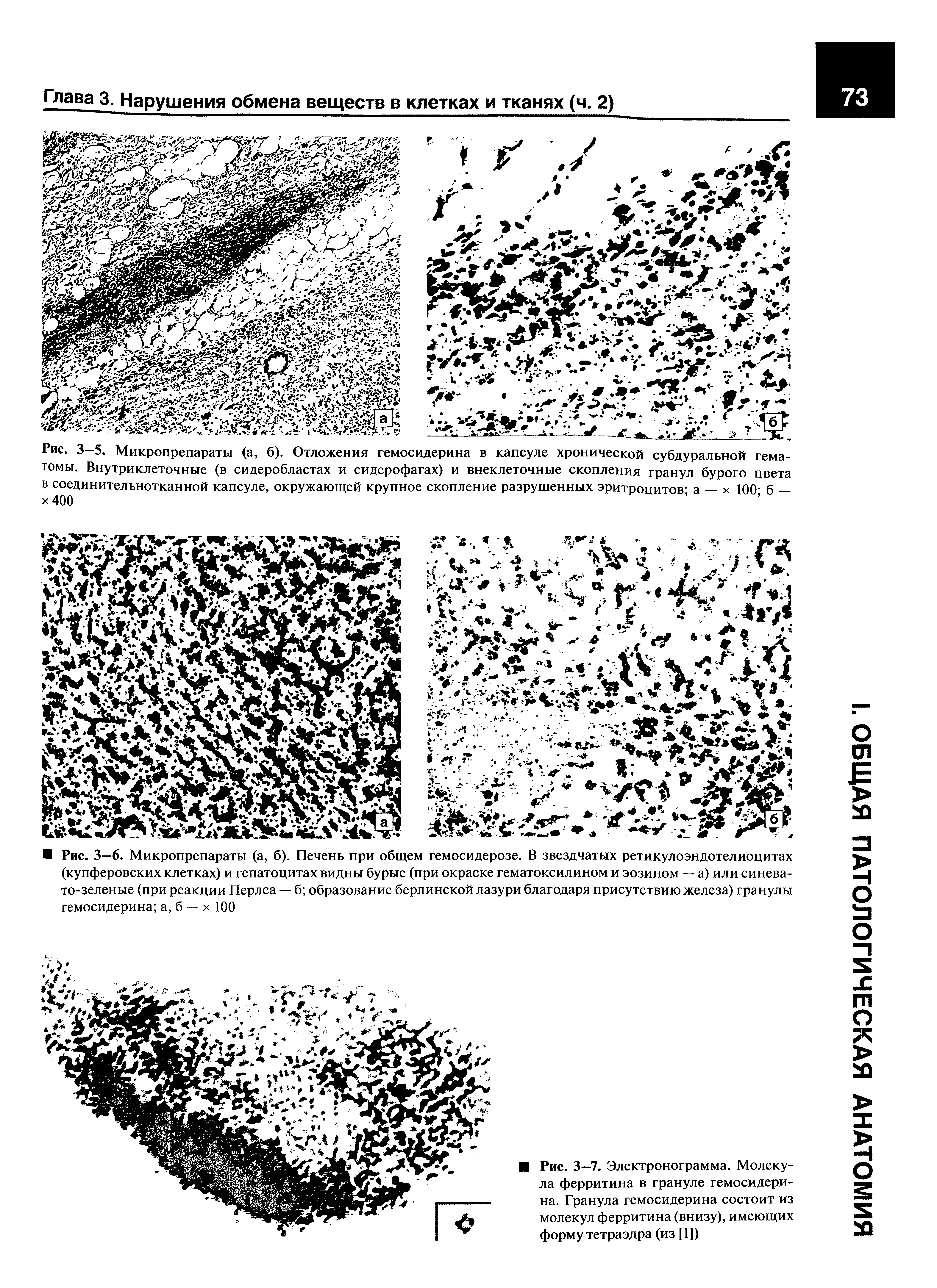 Рис. 3—5. Микропрепараты (а, б). Отложения гемосидерина в капсуле хронической субдуральной гематомы. Внутриклеточные (в сидеробластах и сидерофагах) и внеклеточные скопления гранул бурого цвета в соединительнотканной капсуле, окружающей крупное скопление разрушенных эритроцитов а — х 100 б — х 400 ...