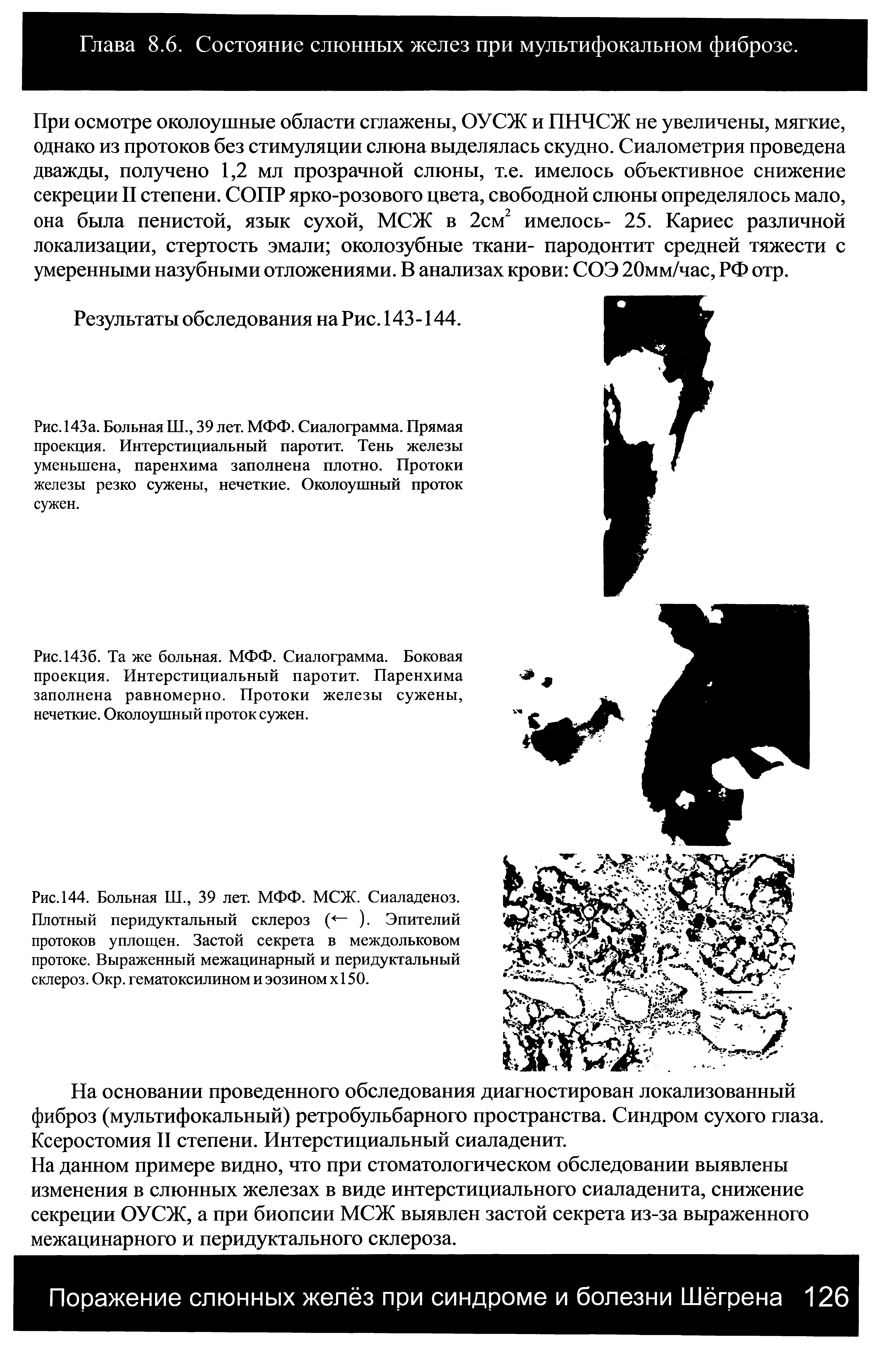 Рис. 144. Больная Ш., 39 лет. МФФ. МСЖ. Сиаладеноз. Плотный перидуктальный склероз (<— ). Эпителий протоков уплощен. Застой секрета в междольковом протоке. Выраженный межацинарный и перидуктальный склероз. Окр. гематоксилином и эозином х 150.