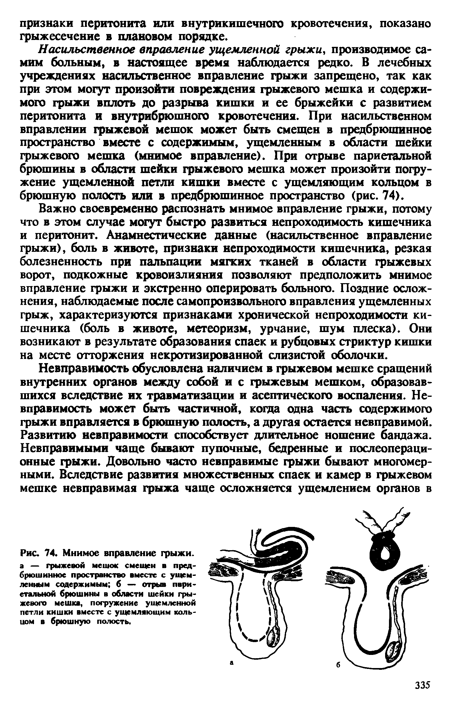 Рис. 74 Мнимое вправление грыжи, а — грыжевой мешок смещен в предбрюшинное пространство вместе с ущемленным содержимым б — отрыв париетальной брюшины в области шейки грыжевого мешка, погружение ущемленной петли кишки вместе с ущемляющим кольцом в брюшную полость.