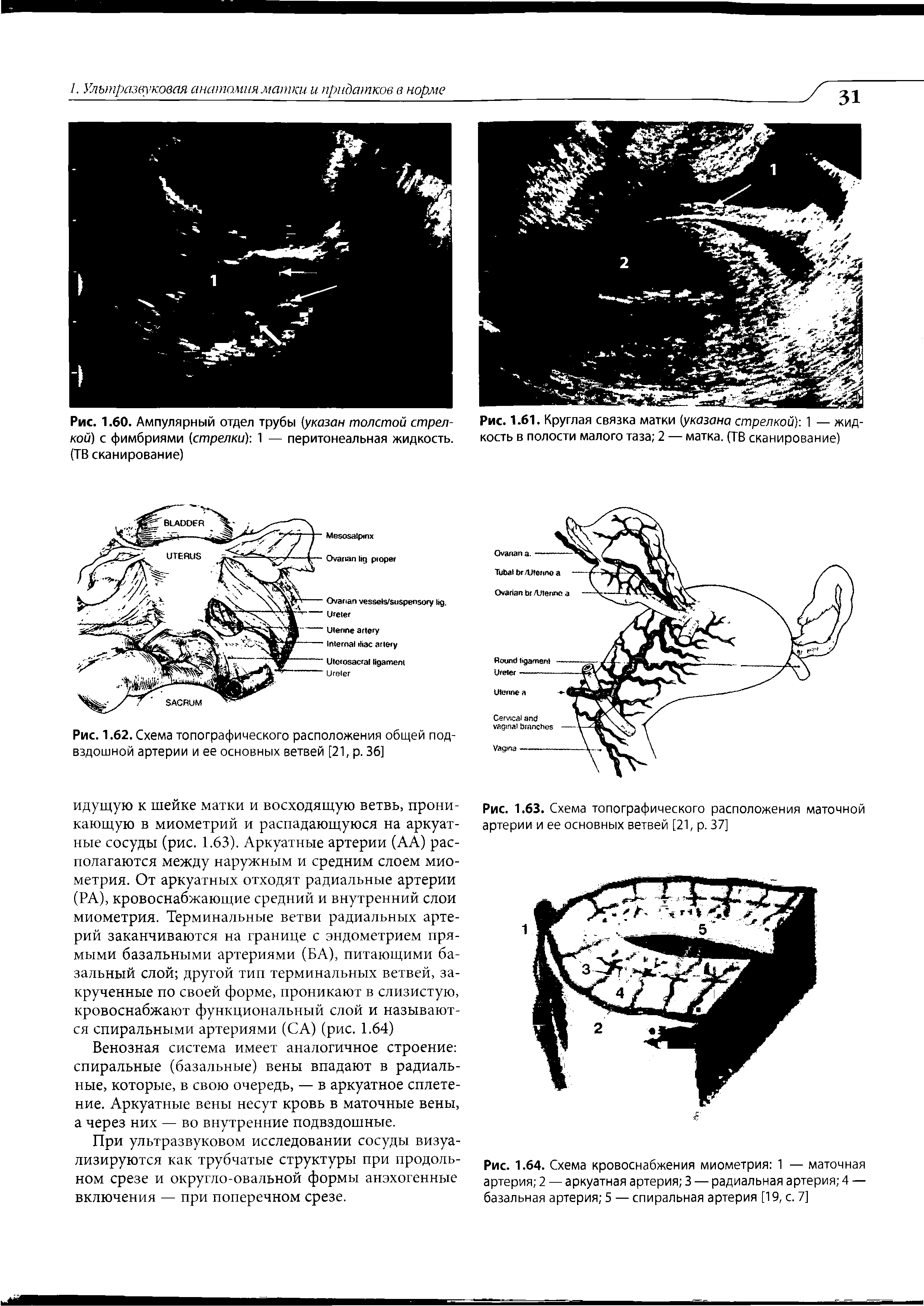 Рис. 1.61. Круглая связка матки (указана стрелкой) 1 — жидкость в полости малого таза 2 — матка. (ТВ сканирование)...