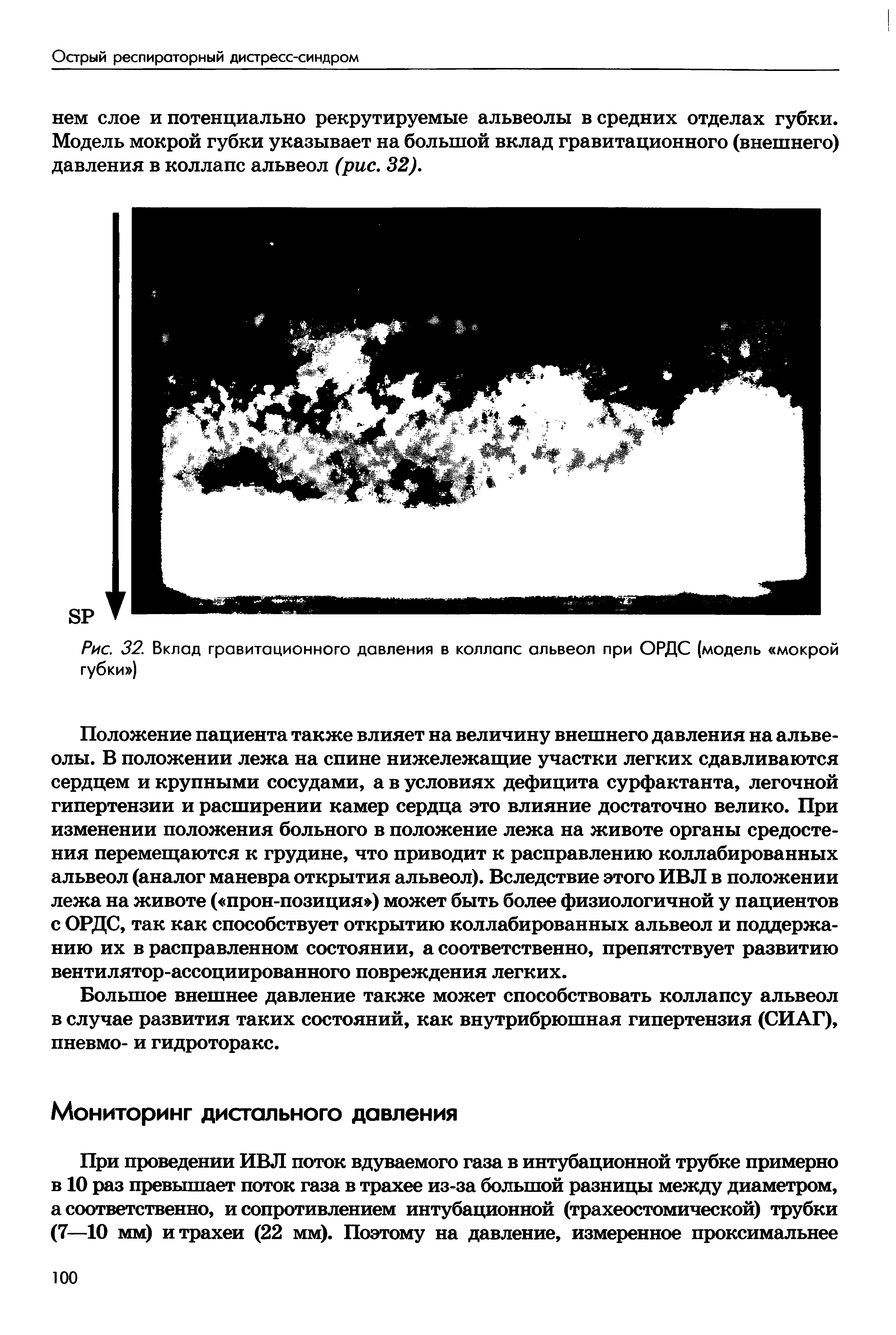 Рис. 32. Вклад гравитационного давления в коллапс альвеол при ОРДС (модель мокрой губки )...