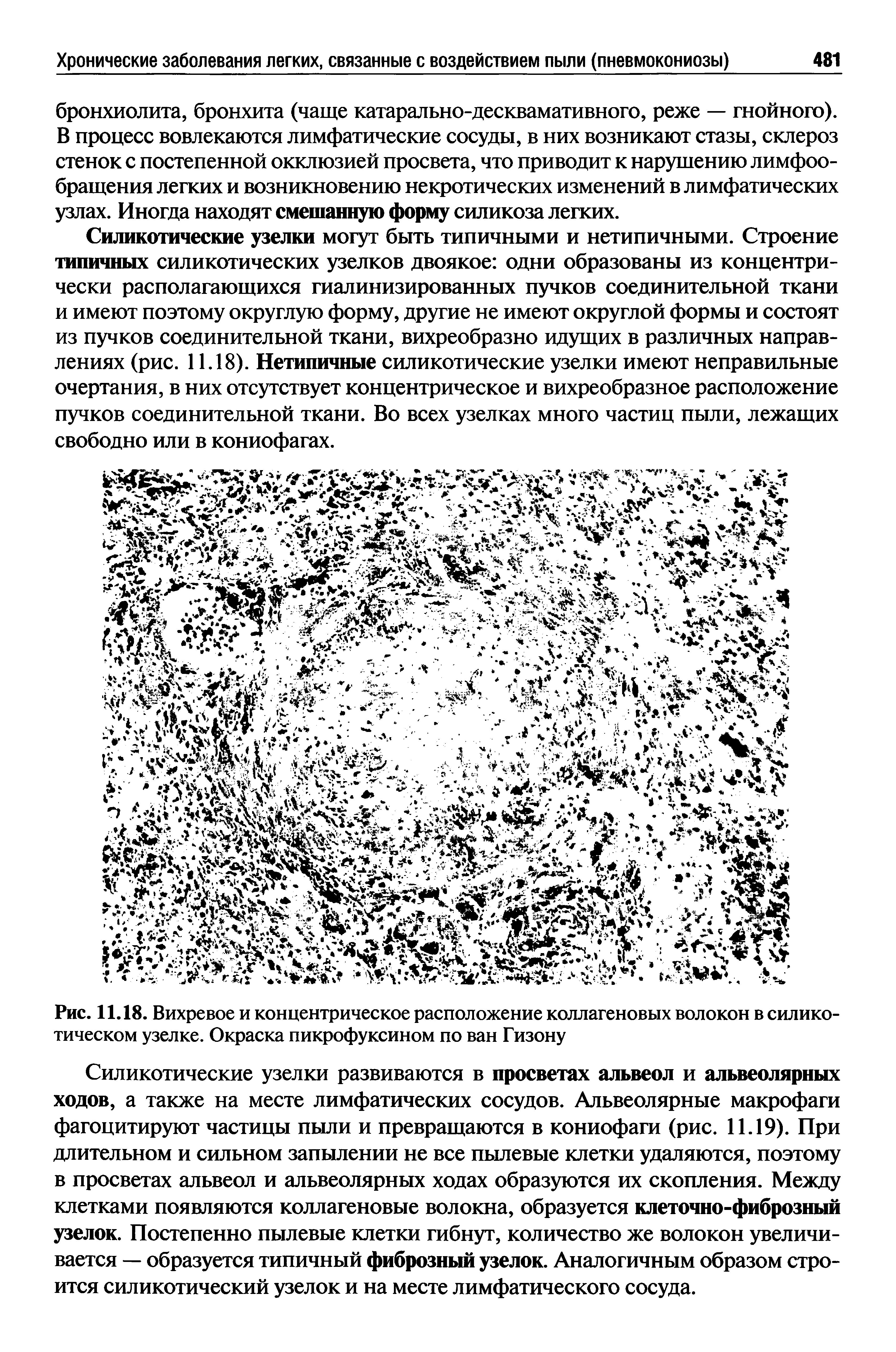 Рис. 11.18. Вихревое и концентрическое расположение коллагеновых волокон в силико-тическом узелке. Окраска пикрофуксином по ван Гизону...