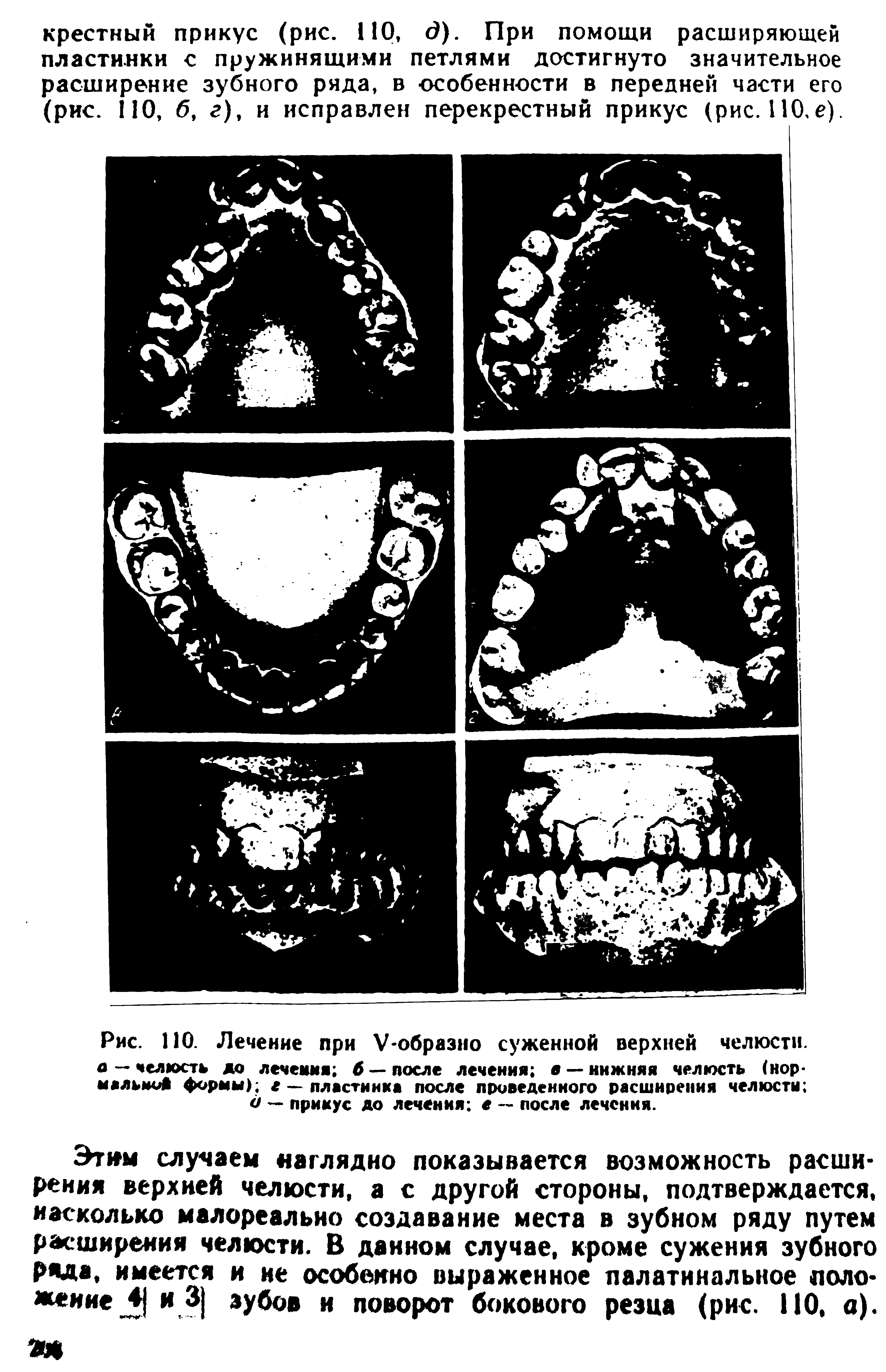 Рис. ПО. Лечение при V-образно суженной верхней челюсти. а — челюсть до лечения 6 — после лечения я —нижняя челюсть (нор-нальни формы) е — пластинка после приведенного расширения челюсти о — прикус до лечения е — после лечения.