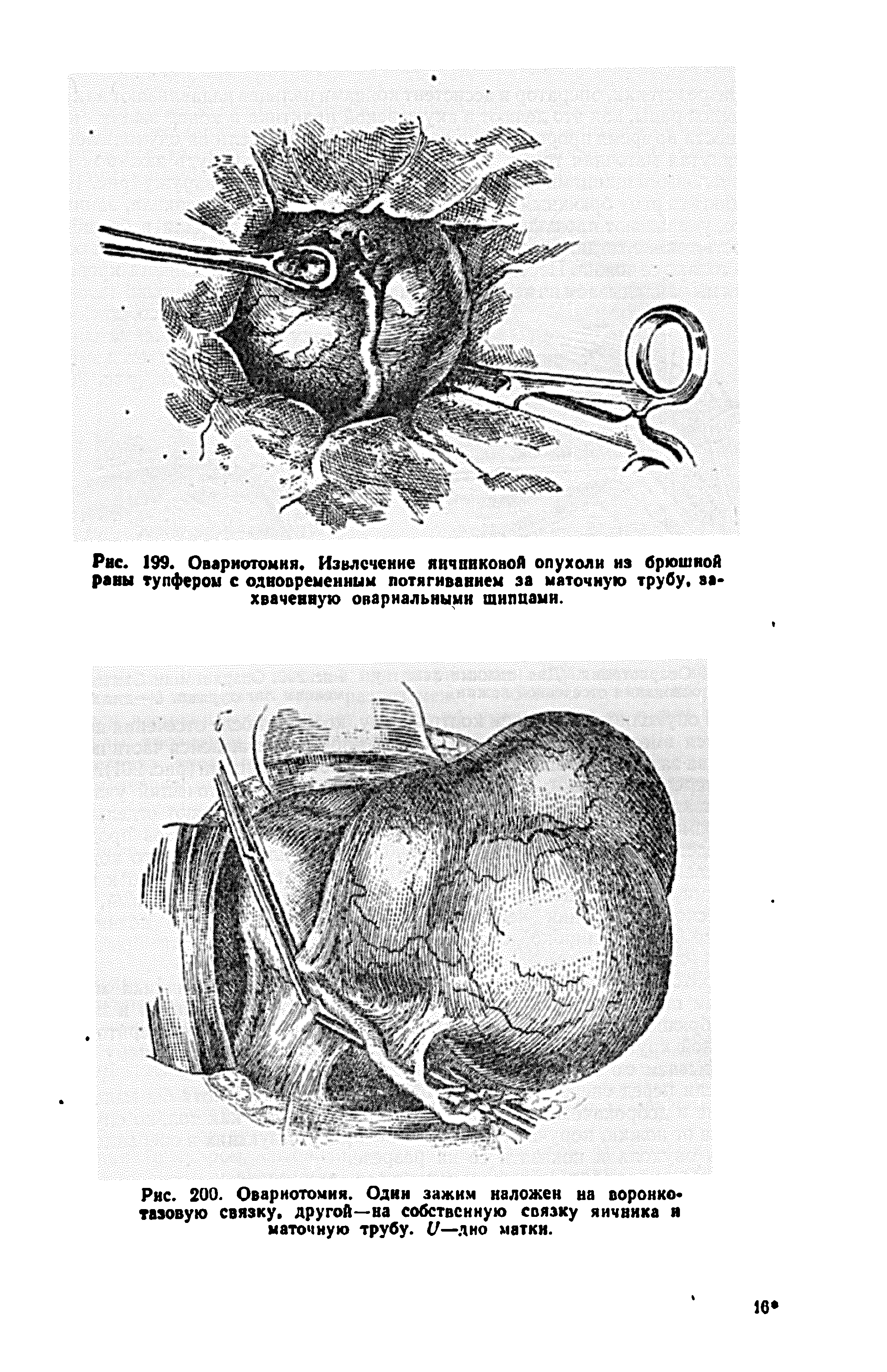 Рис. 200. Овариотомия. Один зажим наложен на воронко тазовую связку, другой—на собственную связку яичника и маточную трубу, и—дно матки.