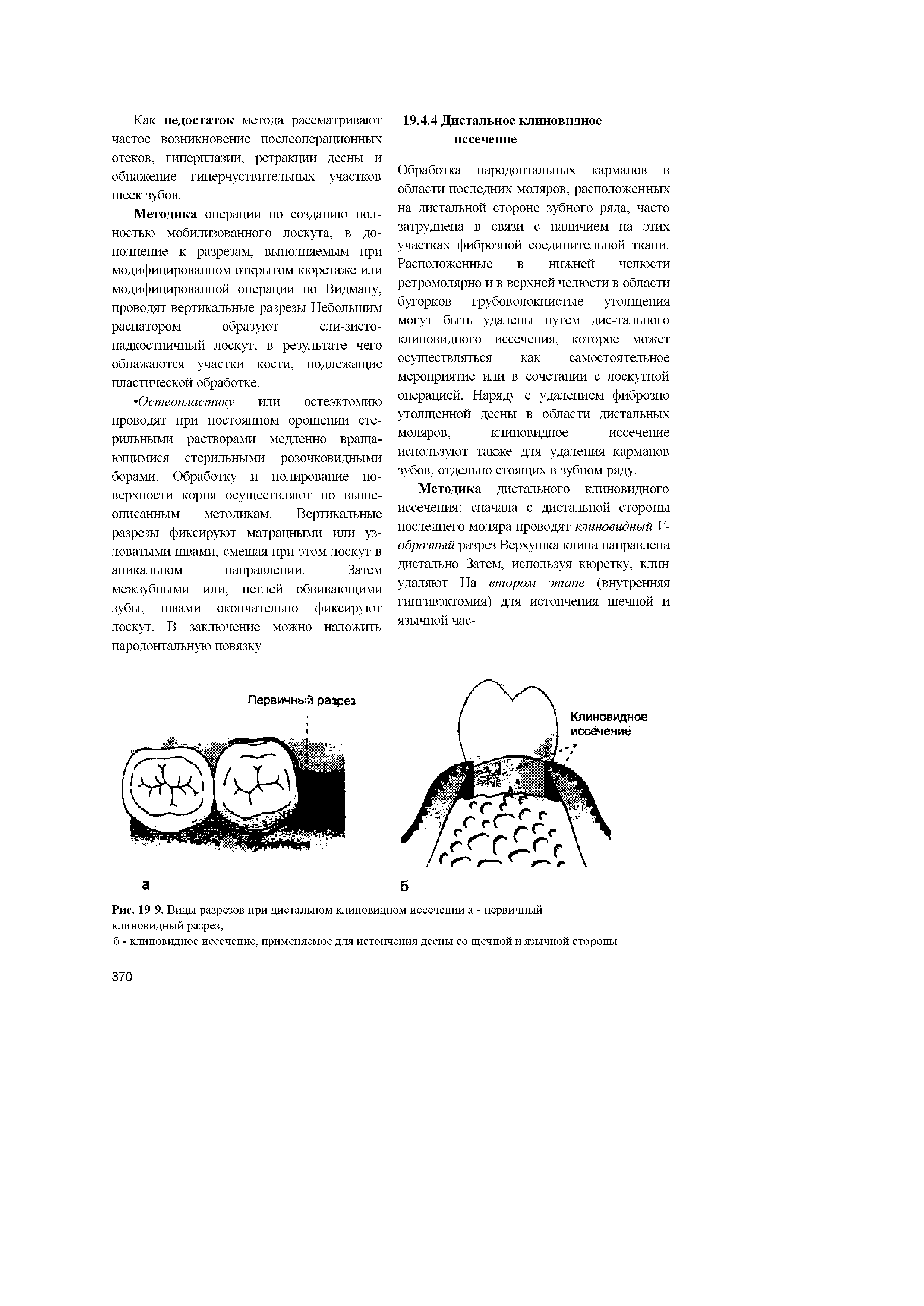 Рис. 19-9. Виды разрезов при дистальном клиновидном иссечении а - первичный клиновидный разрез,...