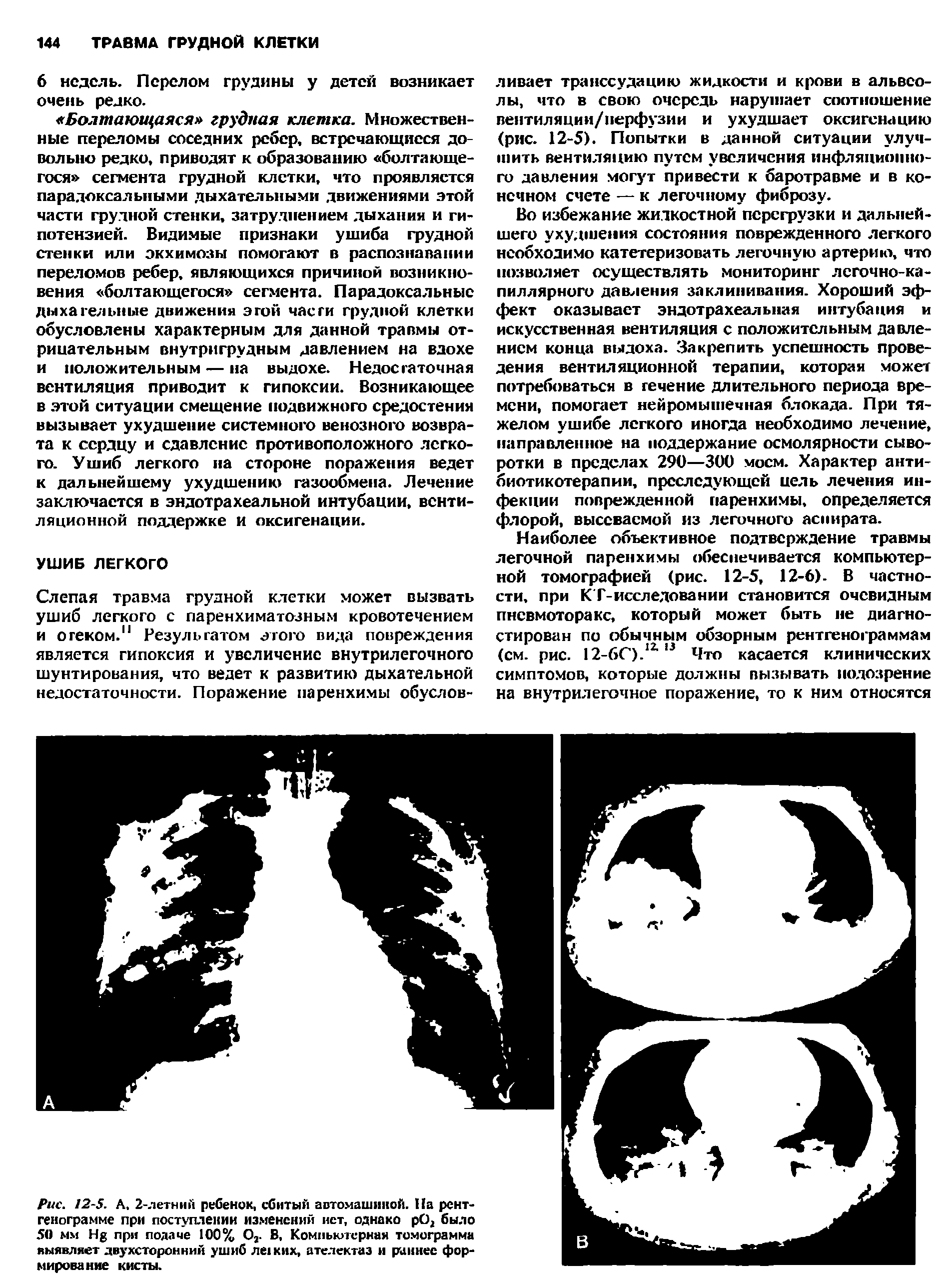 Рис. 12-5. А. 2-летний ребенок, сбитый автомашиной. На рентгенограмме при поступлении изменений нет, однако рО, было 50 мм Нз при подаче 100% О,. В, Компьютерная томограмма выявляет двухсторонний ушиб ле1ких, ателектаз и раннее формирование кисты.