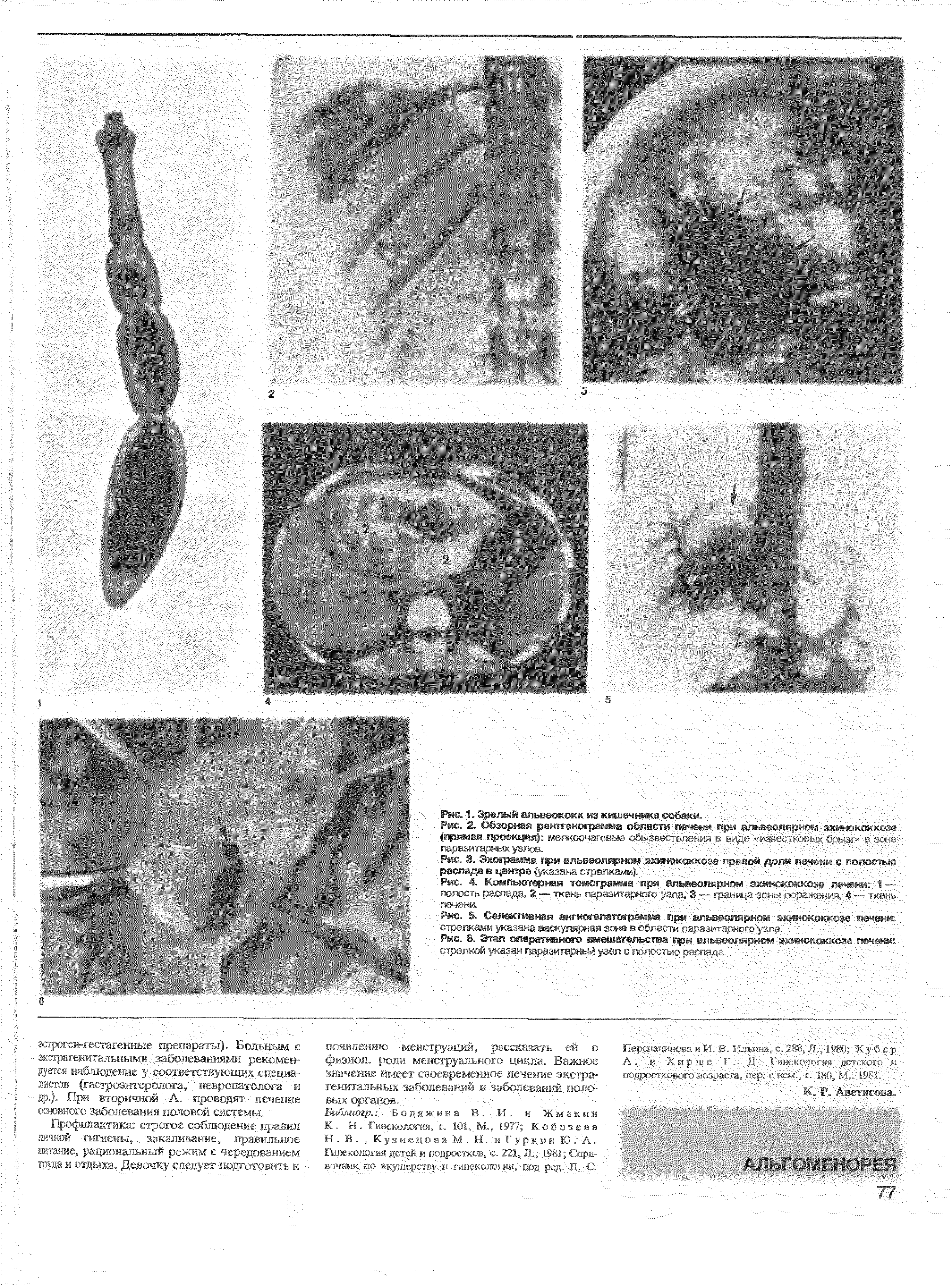 Рис. 4. Компьютерная томограмма при альвеолярном эким г с, ш-ч/м полость распада, 2— ткань парами , < < -ы.тц 3 г н>. ...