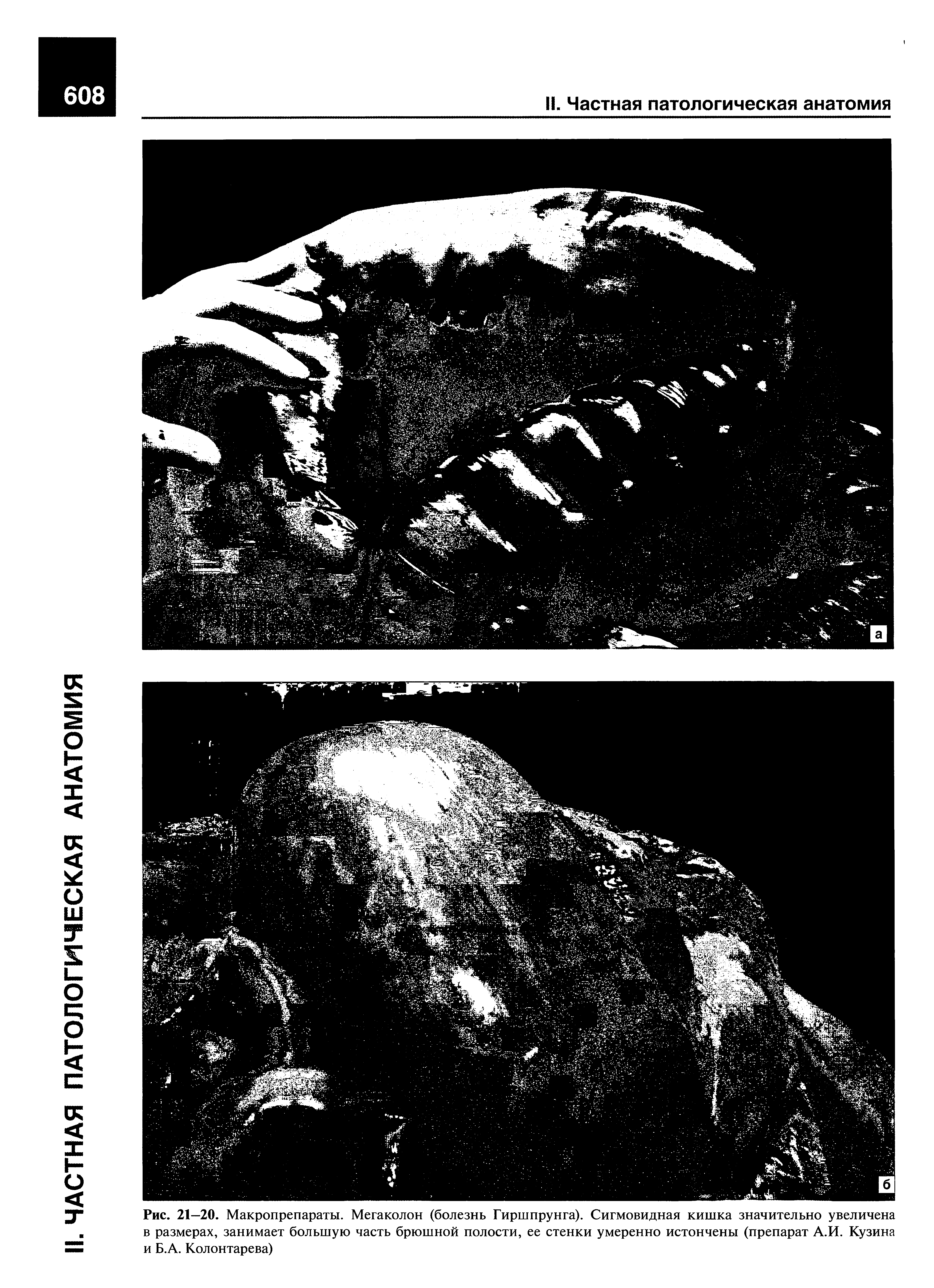 Рис. 21—20. Макропрепараты. Мегаколон (болезнь Гиршпрунга). Сигмовидная кишка значительно увеличена в размерах, занимает большую часть брюшной полости, ее стенки умеренно истончены (препарат А.И. Кузина и Б.А. Колонтарева)...