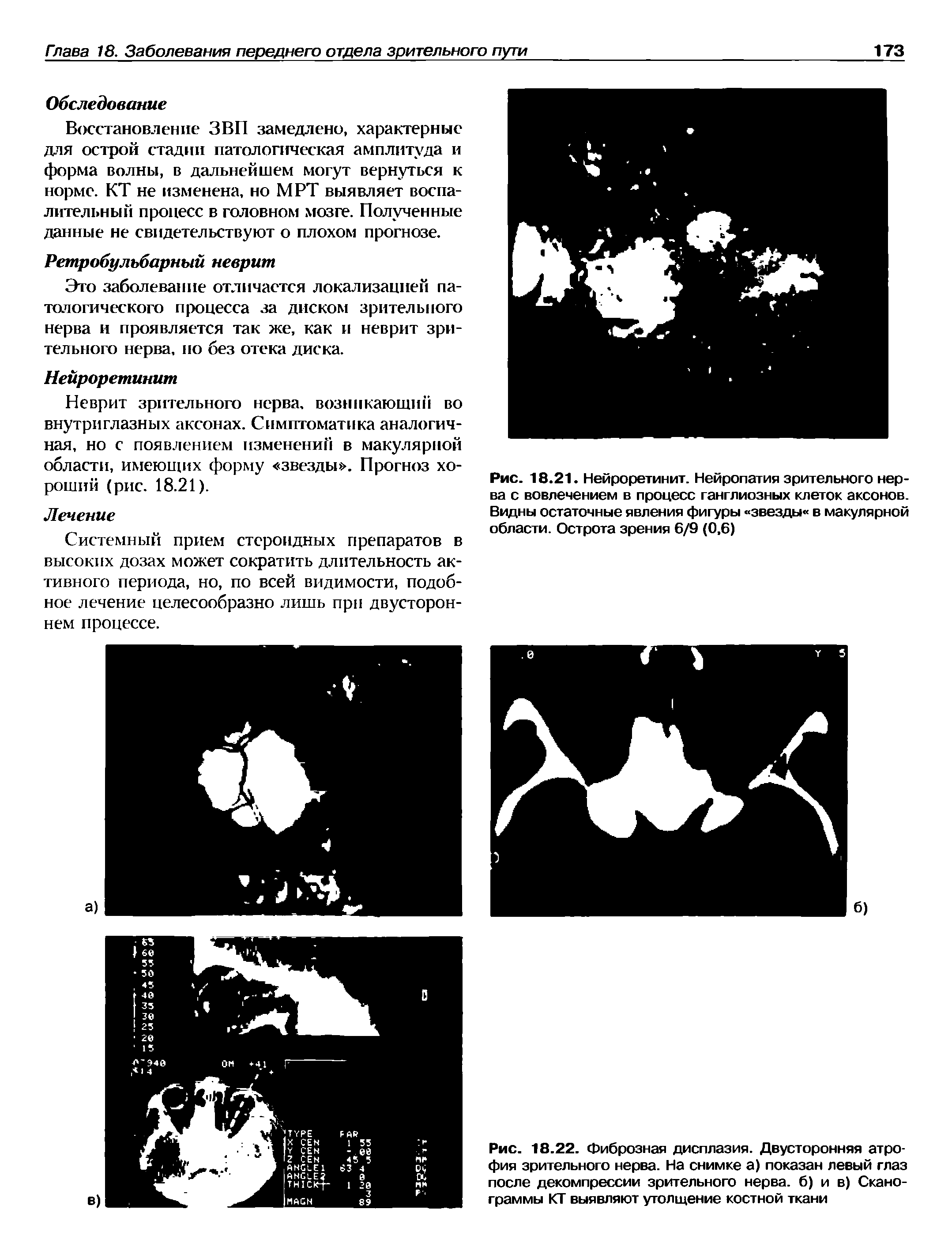 Рис. 18.22. Фиброзная дисплазия. Двусторонняя атрофия зрительного нерва. На снимке а) показан левый глаз после декомпрессии зрительного нерва, б) и в) Сканограммы КТ выявляют утолщение костной ткани...