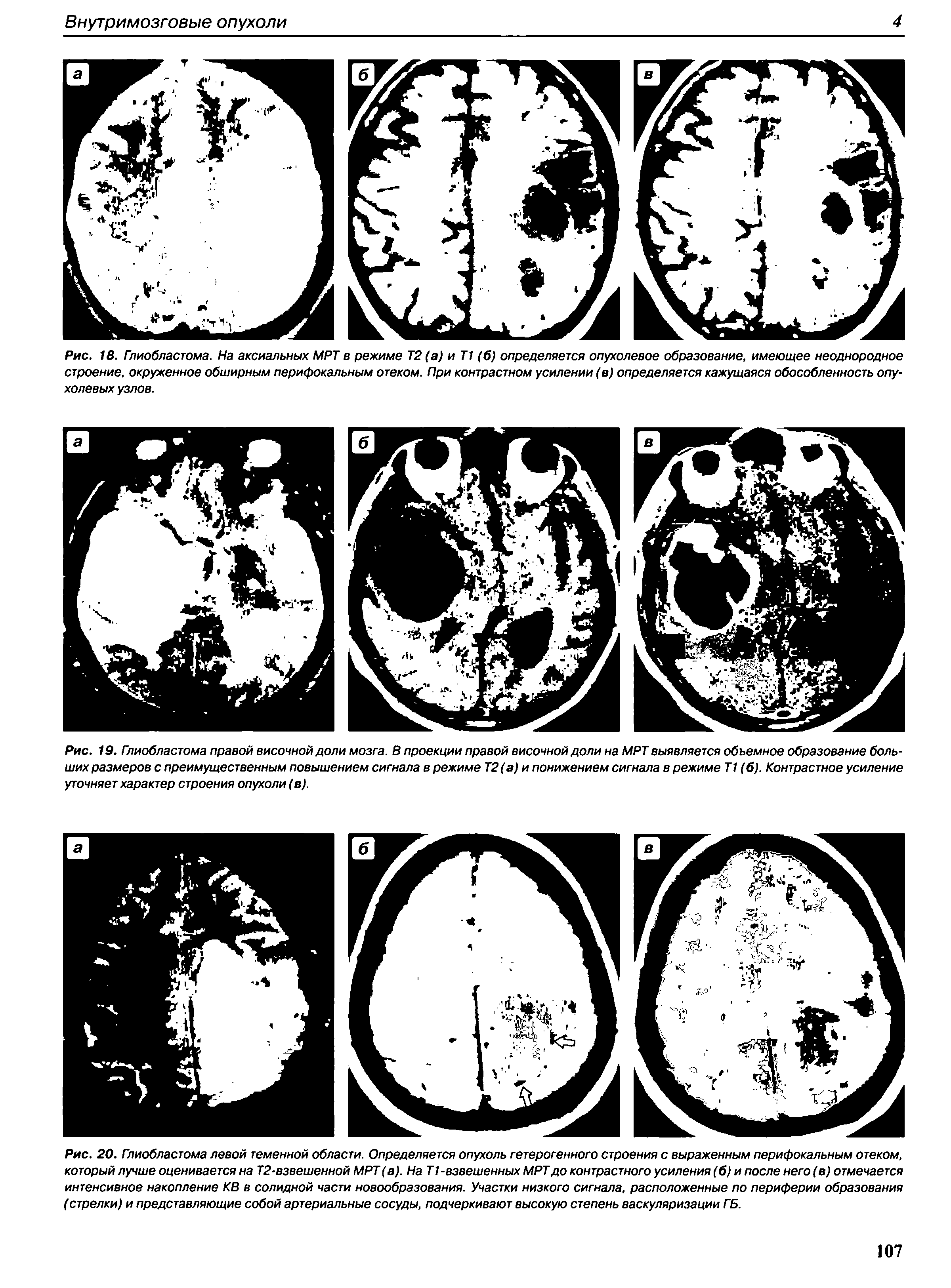 Рис. 19. Глиобластома правой височной доли мозга. В проекции правой височной доли на МРТ выявляется объемное образование больших размеров с преимущественным повышением сигнала в режиме Т2(а) и понижением сигнала в режиме Т1 (б). Контрастное усиление уточняет характер строения опухоли (в).