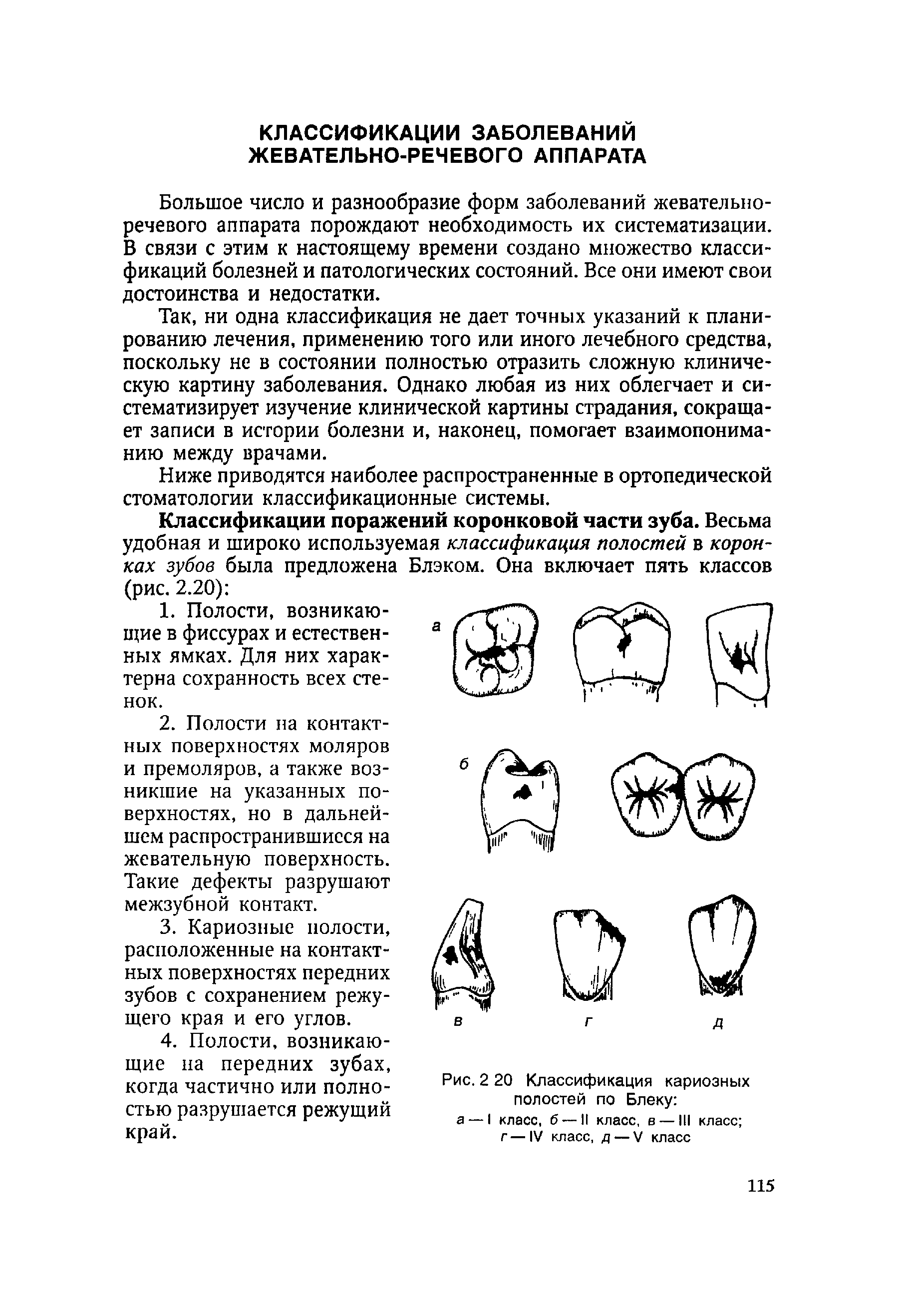 Рис. 2 20 Классификация кариозных полостей по Блеку а — I класс, б — II класс, в — III класс ...