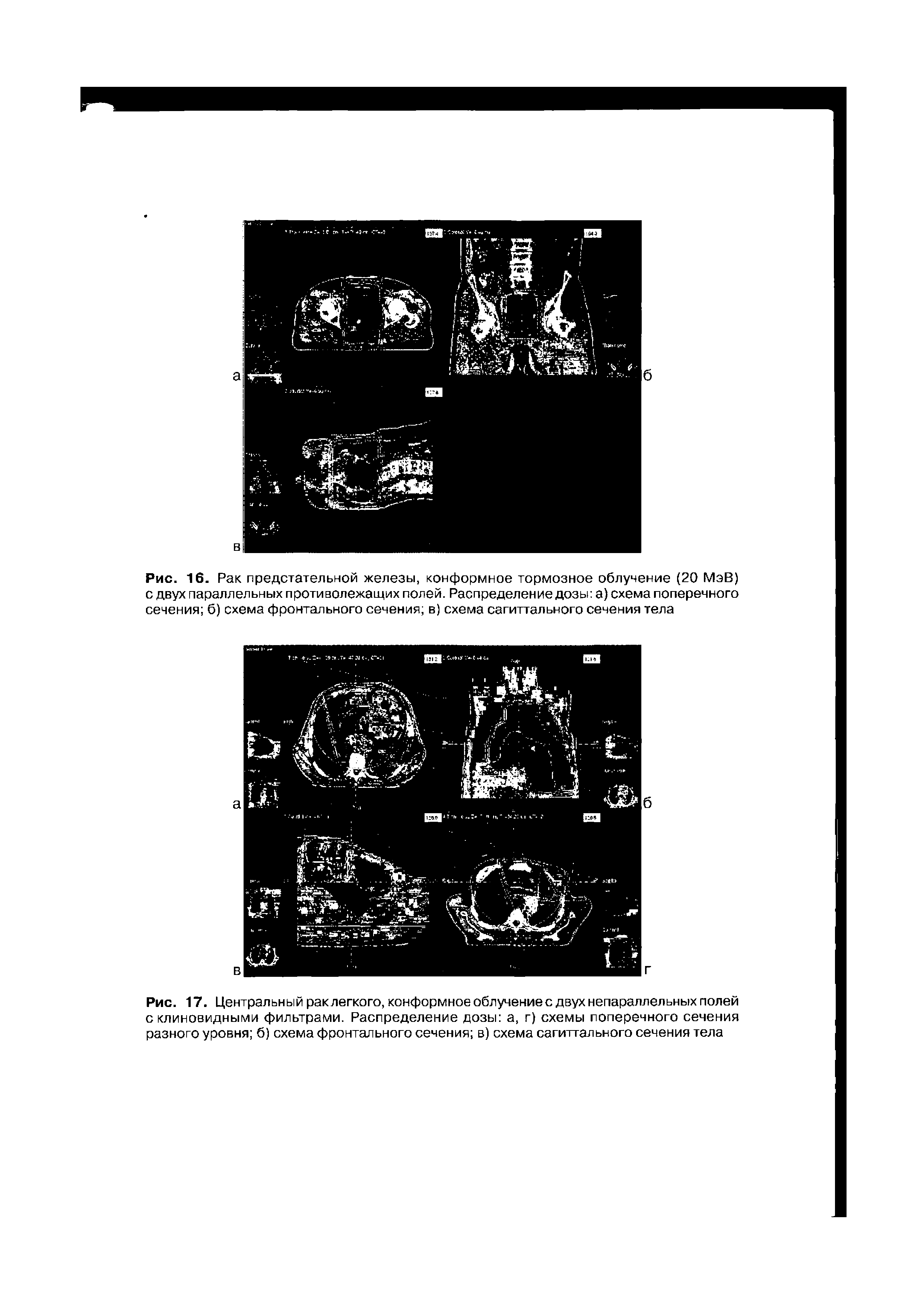 Рис. 17. Центральный рак легкого, конформное облучение с двух непараллельных полей с клиновидными фильтрами. Распределение дозы а, г) схемы поперечного сечения разного уровня б) схема фронтального сечения в) схема сагиттального сечения тела...