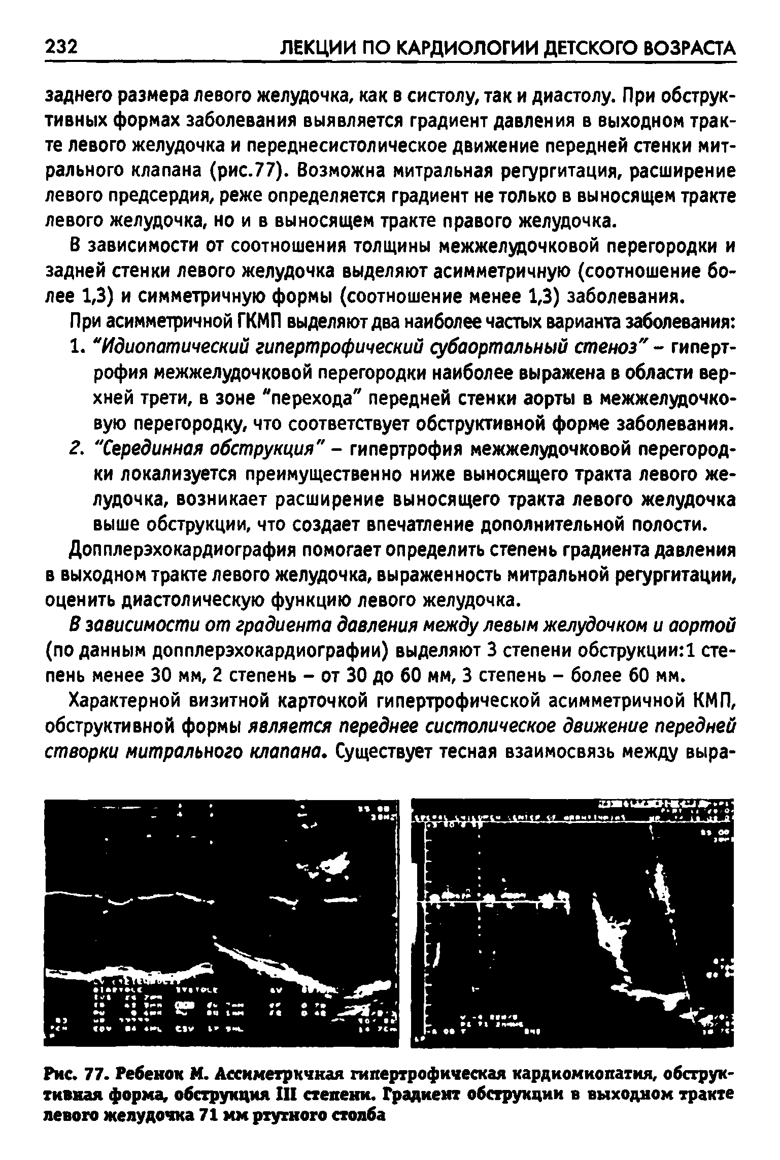 Рис. 77. Ребенок М. Ассиметркчная гипертрофическая кардиомиопатия, обструктивная форма, обструкция III степени. Градиент обструкции в выходном тракте левого желудочка 71 мм ртутного столба...