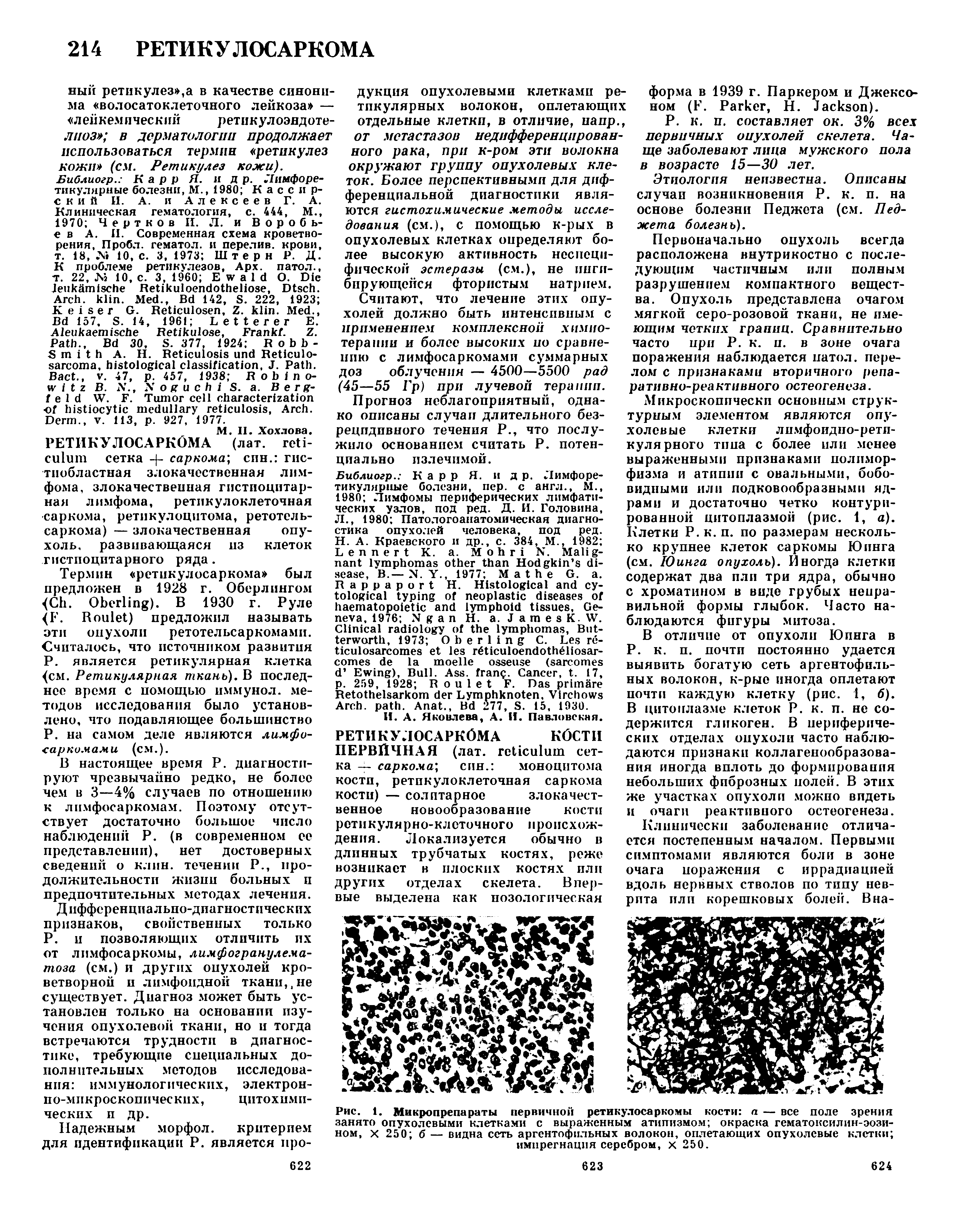 Рис. 1. Микропрепараты первичной ретикулосаркомы кости а — все поле зрения занято опухолевыми клетками с выраженным атипизмом окраска гематоксилин-эози-ном, х 250 б — видна сеть аргентофильных волокон, оплетающих опухолевые клетки импрегнация серебром, х 250.