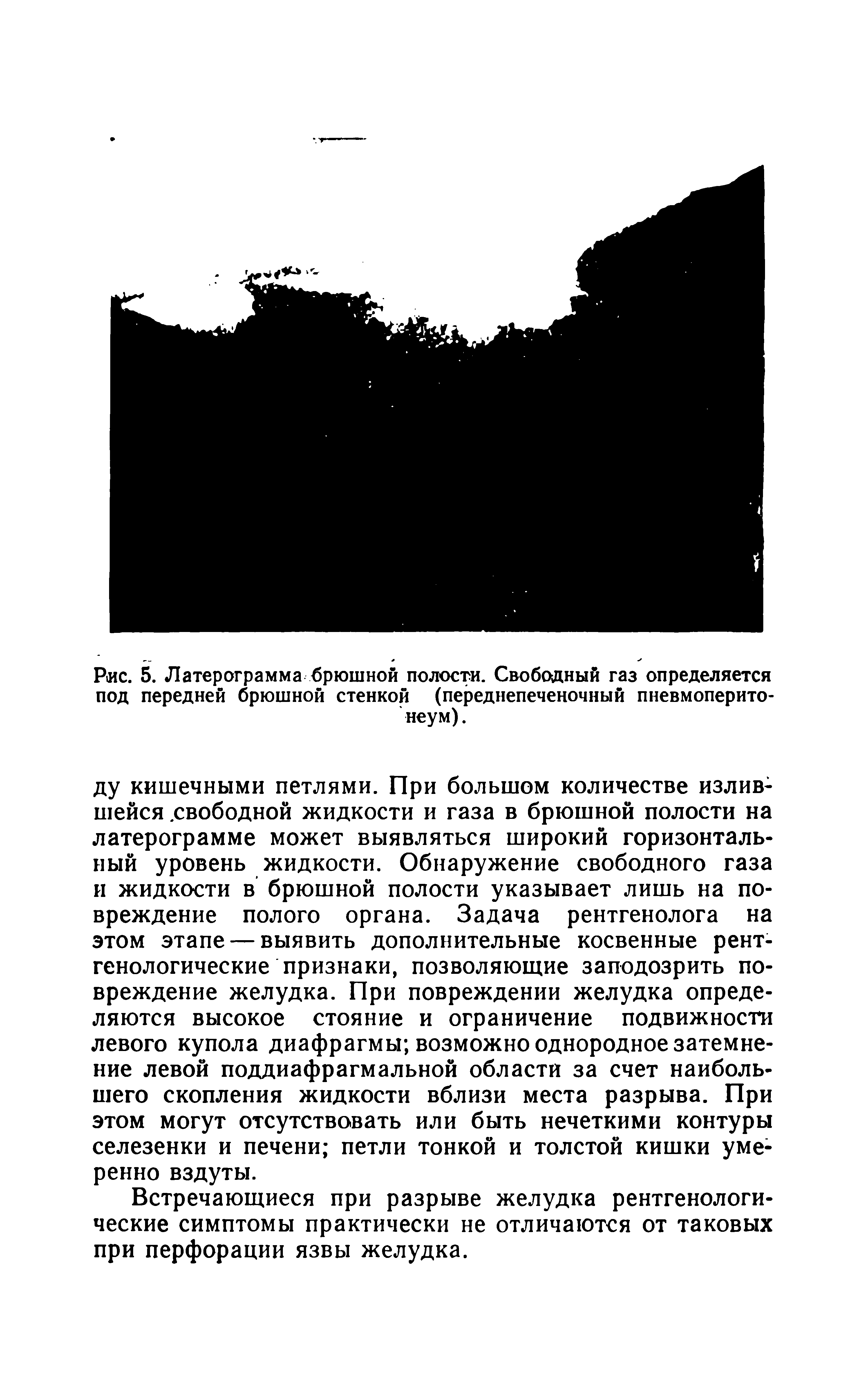 Рис. 5. Латерограмма брюшной полости. Свободный газ определяется под передней брюшной стенкой (переднепеченочный пневмоперито-неум).