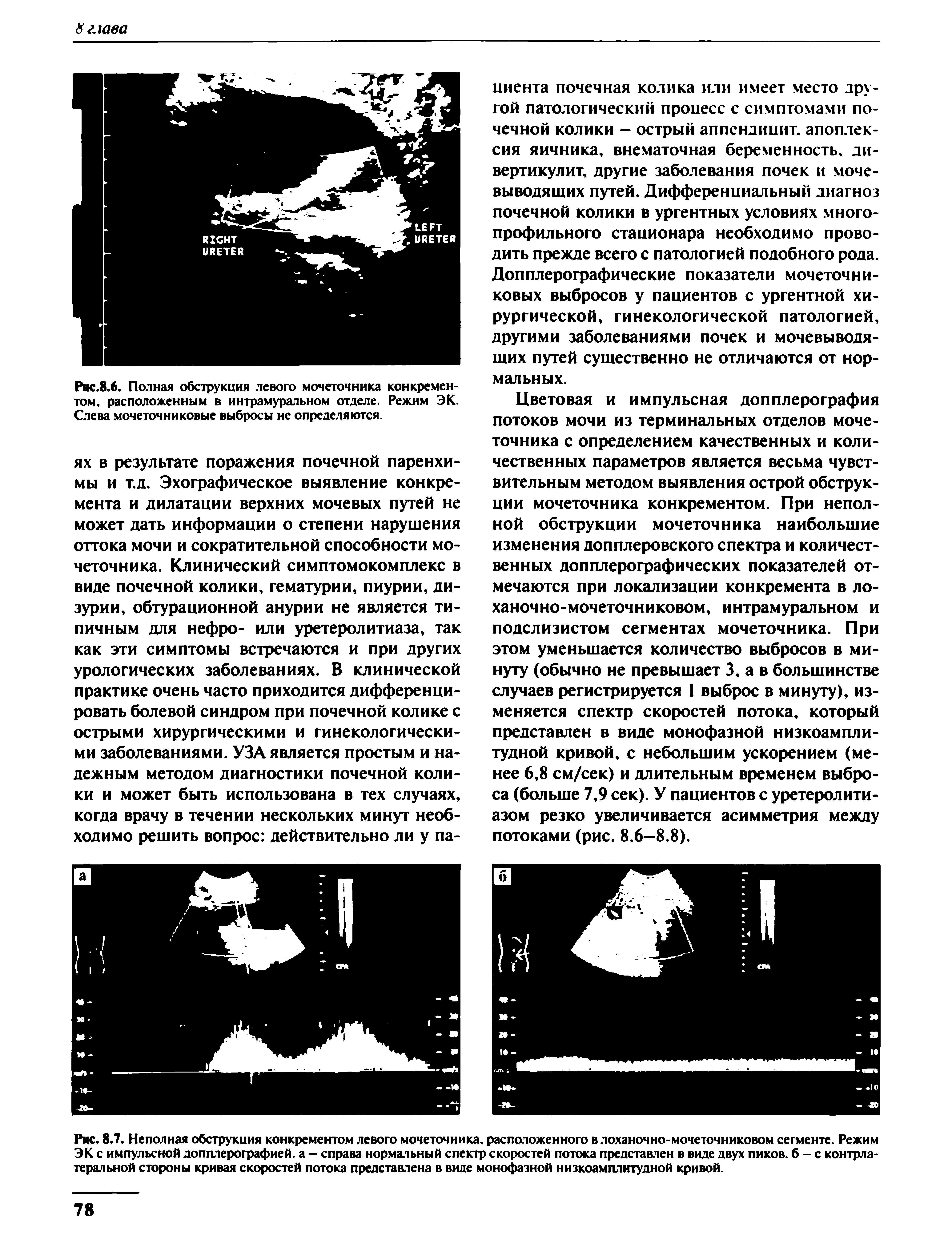 Рис.8.6. Полная обструкция левого мочеточника конкрементом. расположенным в интрамуральном отделе. Режим ЭК. Слева мочеточниковые выбросы не определяются.