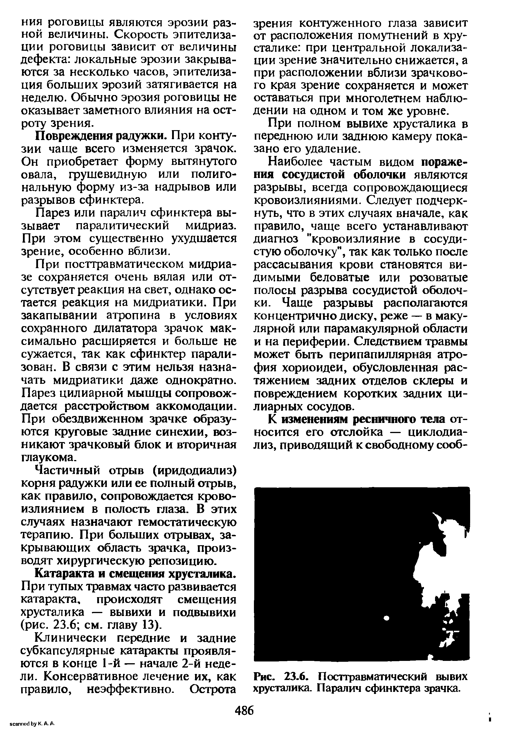 Рис. 23.6. Посттравматический вывих хрусталика. Паралич сфинктера зрачка.