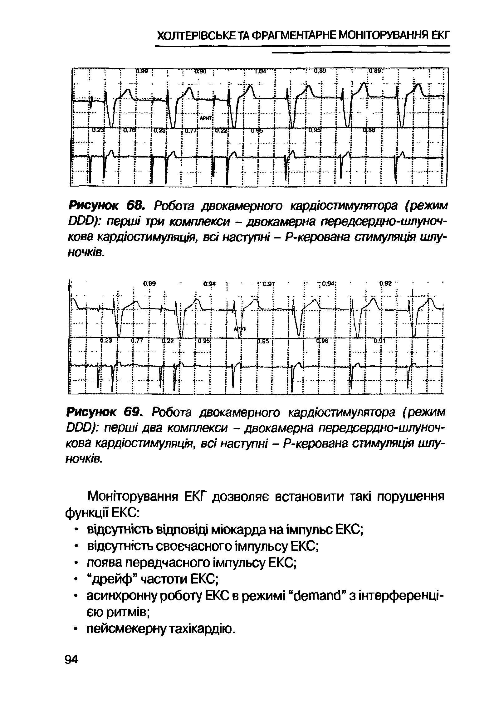 Рисунок 68. Робота двокамерного кардюстимулятора (режим DDD) перш/ три комплексы - двокамерна передсердно-шлуноч-кова кардюстимуляц/я, вс/ наступи/ - Р-керована стимуляц/я шлу-ночюв.