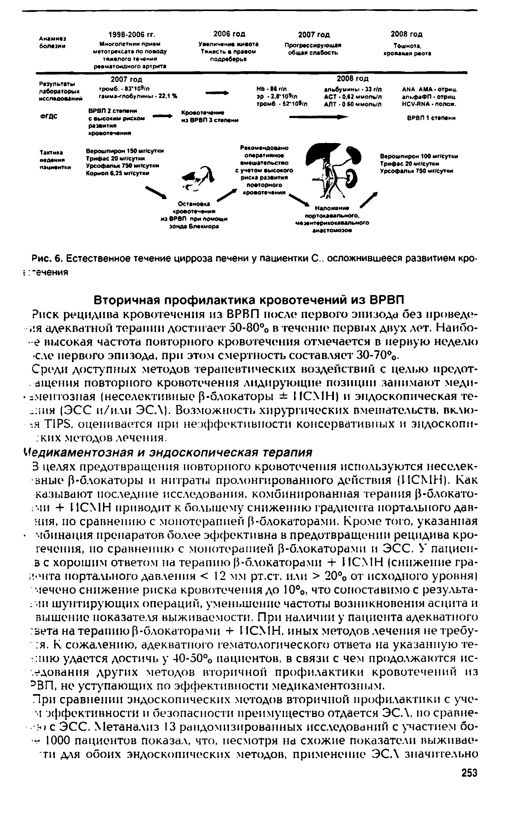 Рис. 6. Естественное течение цирроза печени у пациентки С., осложнившееся развитием кро- -ечения...