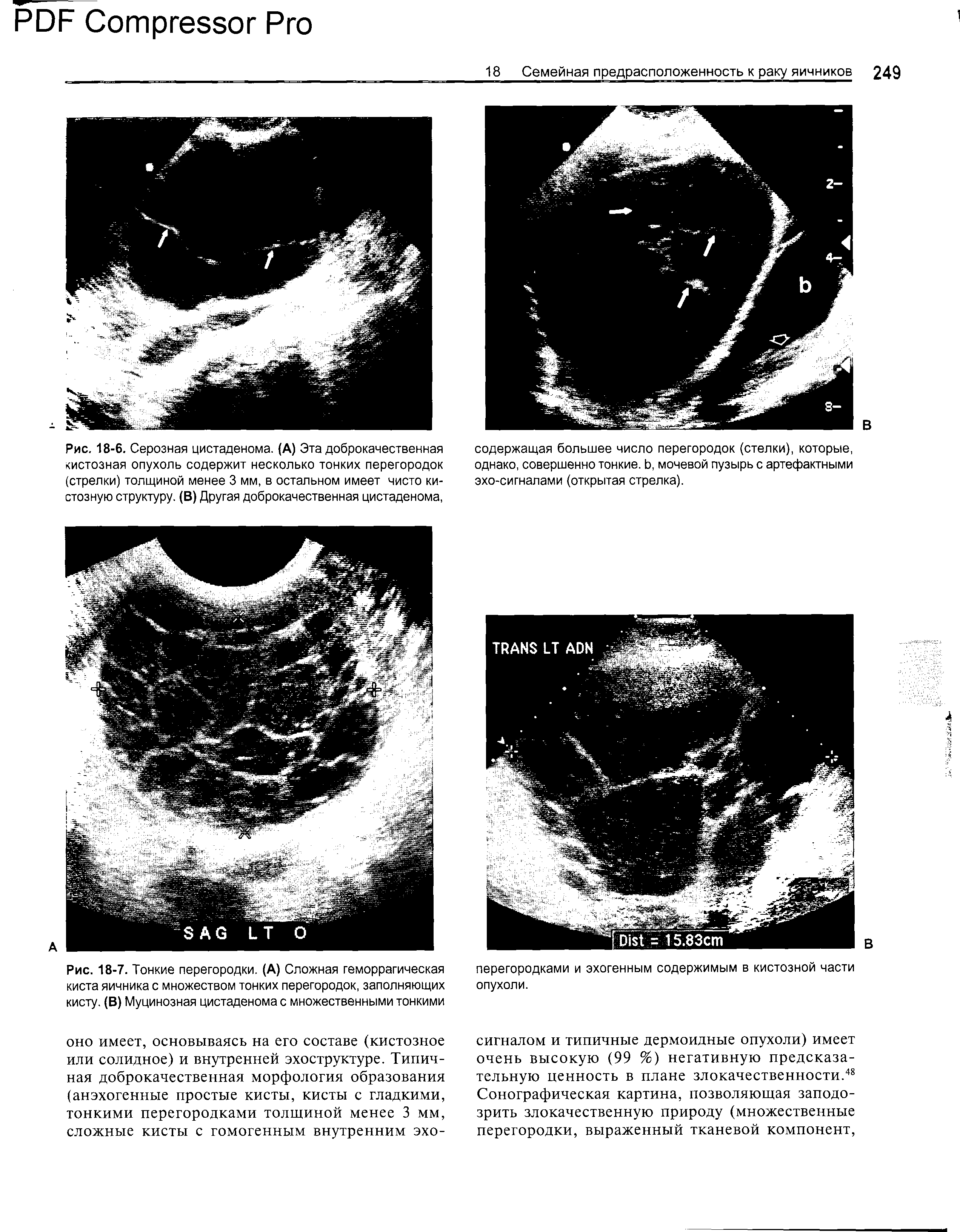 Рис. 18-7. Тонкие перегородки. (А) Сложная геморрагическая киста яичника с множеством тонких перегородок, заполняющих кисту. (В) Муцинозная цистаденома с множественными тонкими...