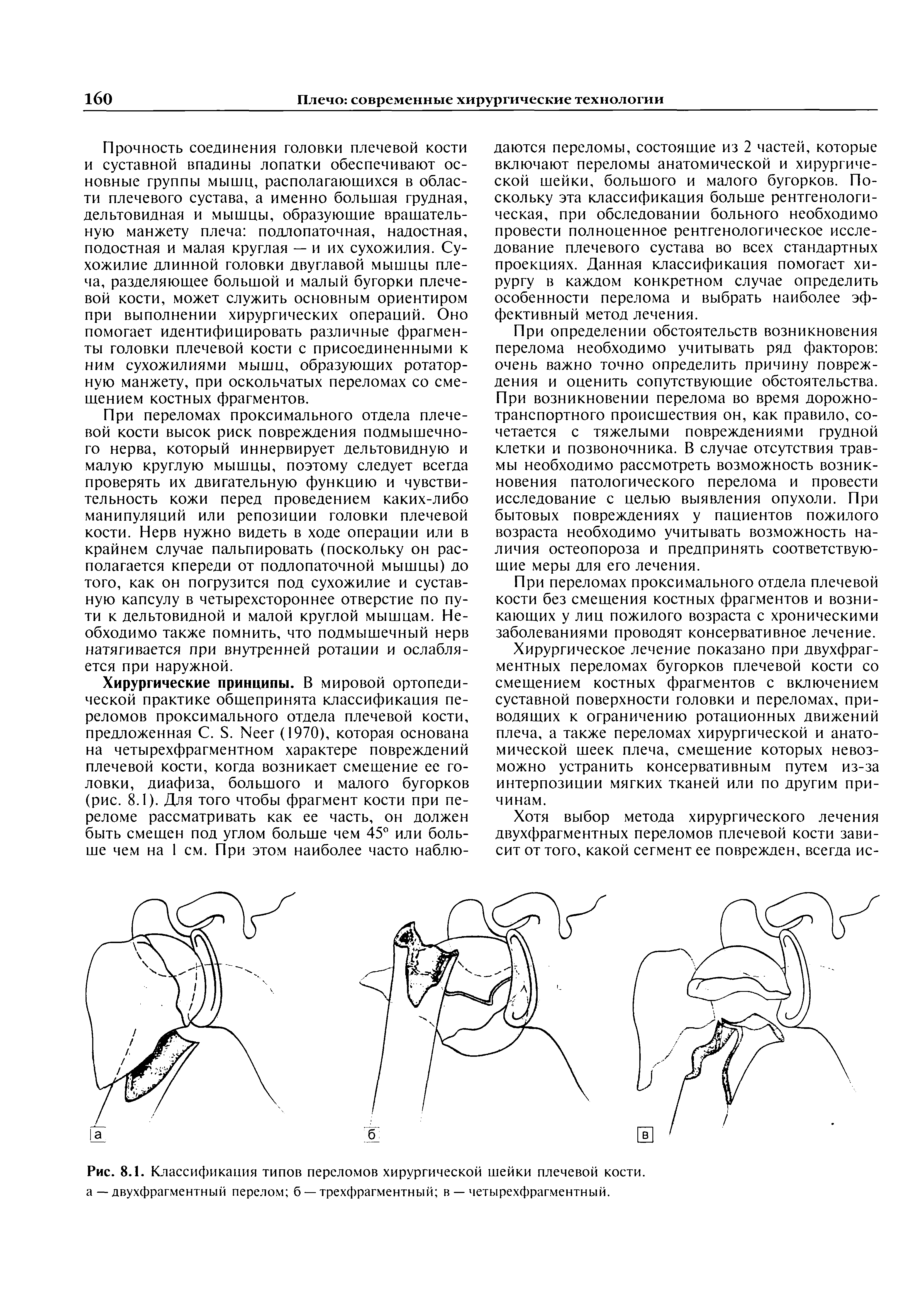 Рис. 8.1. Классификация типов переломов хирургической шейки плечевой кости, а — двухфрагментный перелом б — трехфрагментный в — четырехфрагментный.