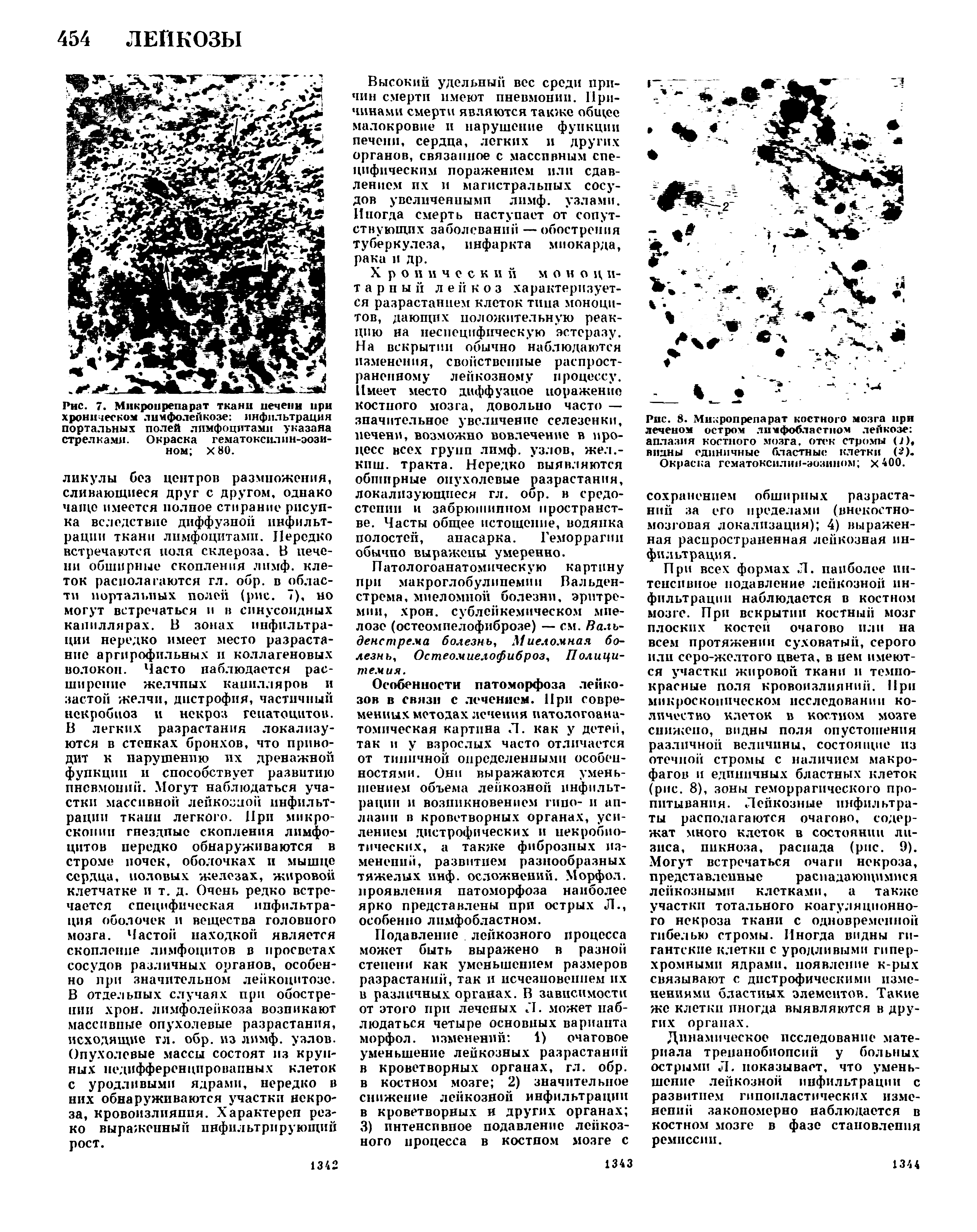 Рис. 7. Мнкроирепарат ткани печени при хроническом лимфолейкозе инфильтрация портальных полей лимфоцитами указана стрелками. Окраска гематоксилин-эози-ном Х80.