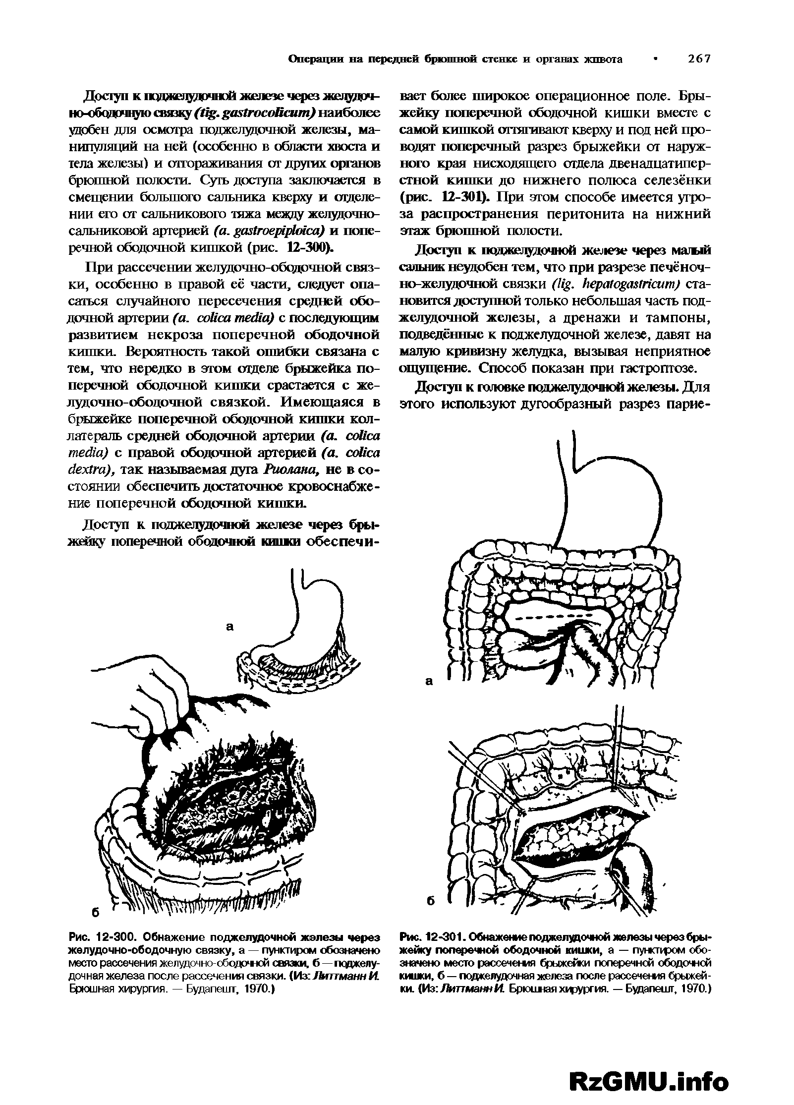 Рис. 12-301. Обнажение поджелудочной железы через брыжейку поперечной ободочной кишки, а — пункпром обозначено место рассечения брыжейки поперечной ободочной кишки, б — поджелудочная железа после рассечения брыжейки. (Из ЛиттманнМ Брючная хцэургия. — Будапешт, 1970.)...