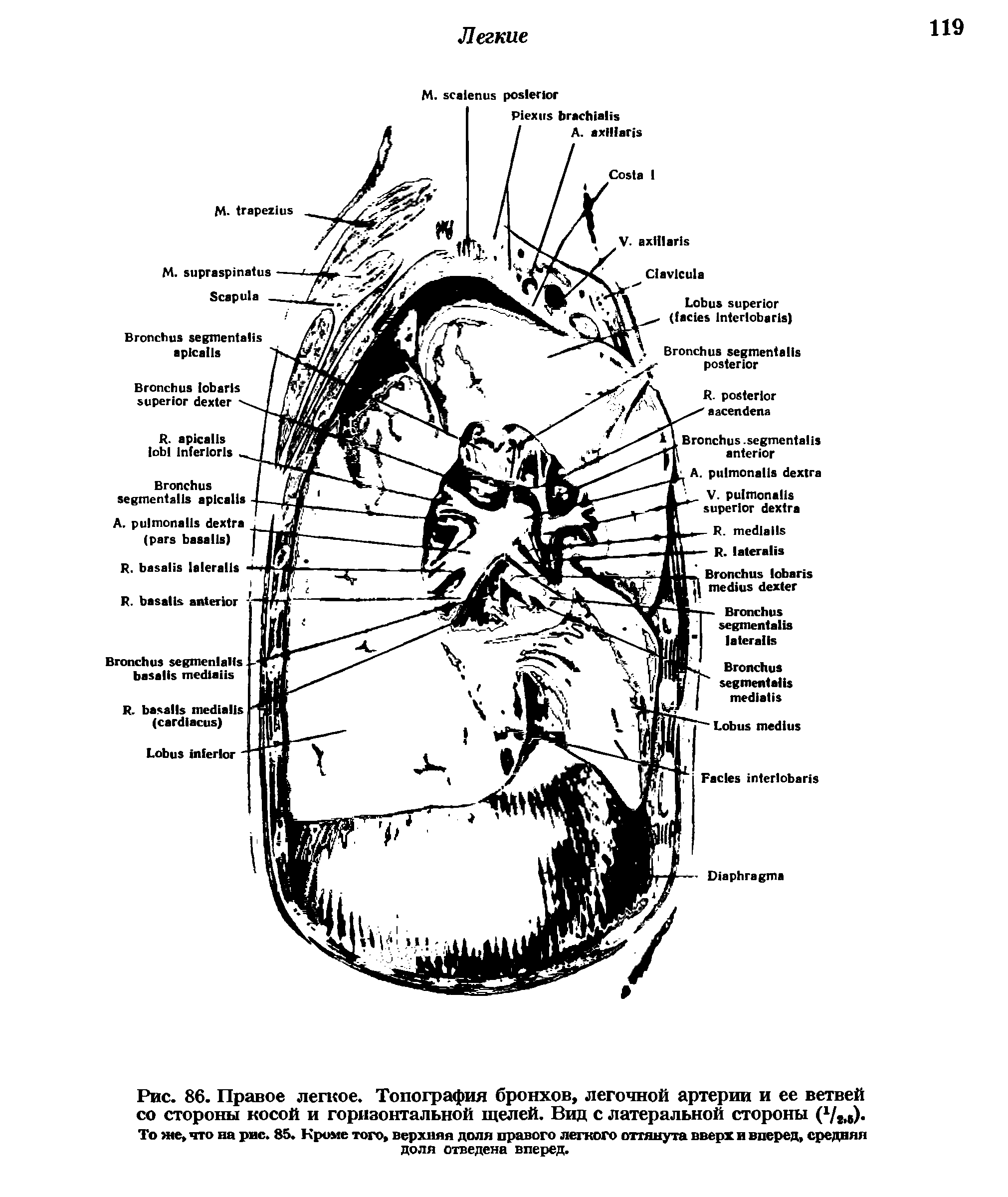 Рис. 86. Правое легкое. Топография бронхов, легочной артерии и ее ветвей со стороны косой и горизонтальной щелей. Вид с латеральной стороны (Чы)-То же, что на рис. 85. Кроме того, верхняя доля правого легкого оттянута вверх и вперед, средняя доля отведена вперед.