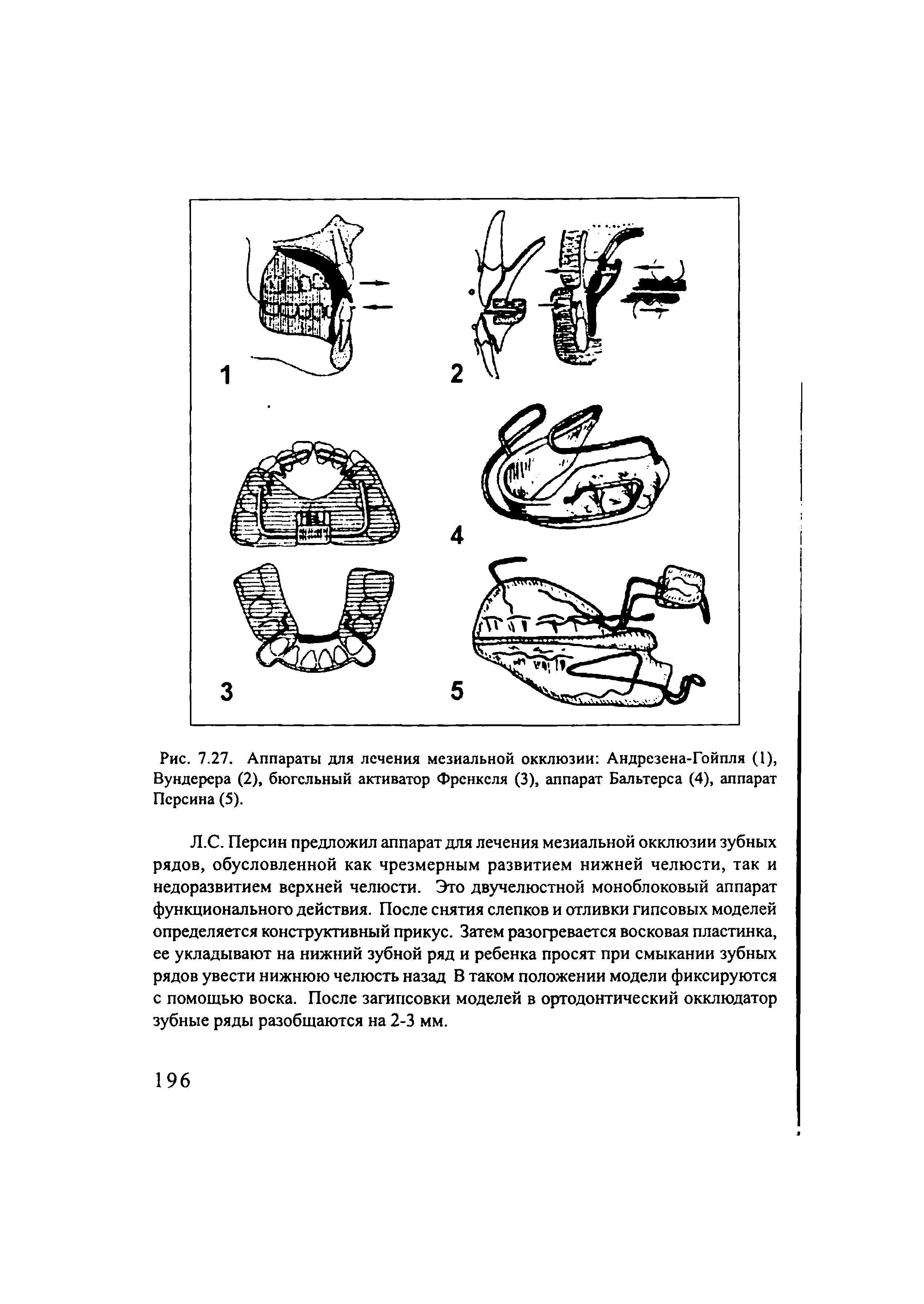 Рис. 7.27. Аппараты для лечения мезиальной окклюзии Андрезена-Гойпля (1), Вундерера (2), бюгсльный активатор Френкеля (3), аппарат Бальтерса (4), аппарат Псрсина (5).