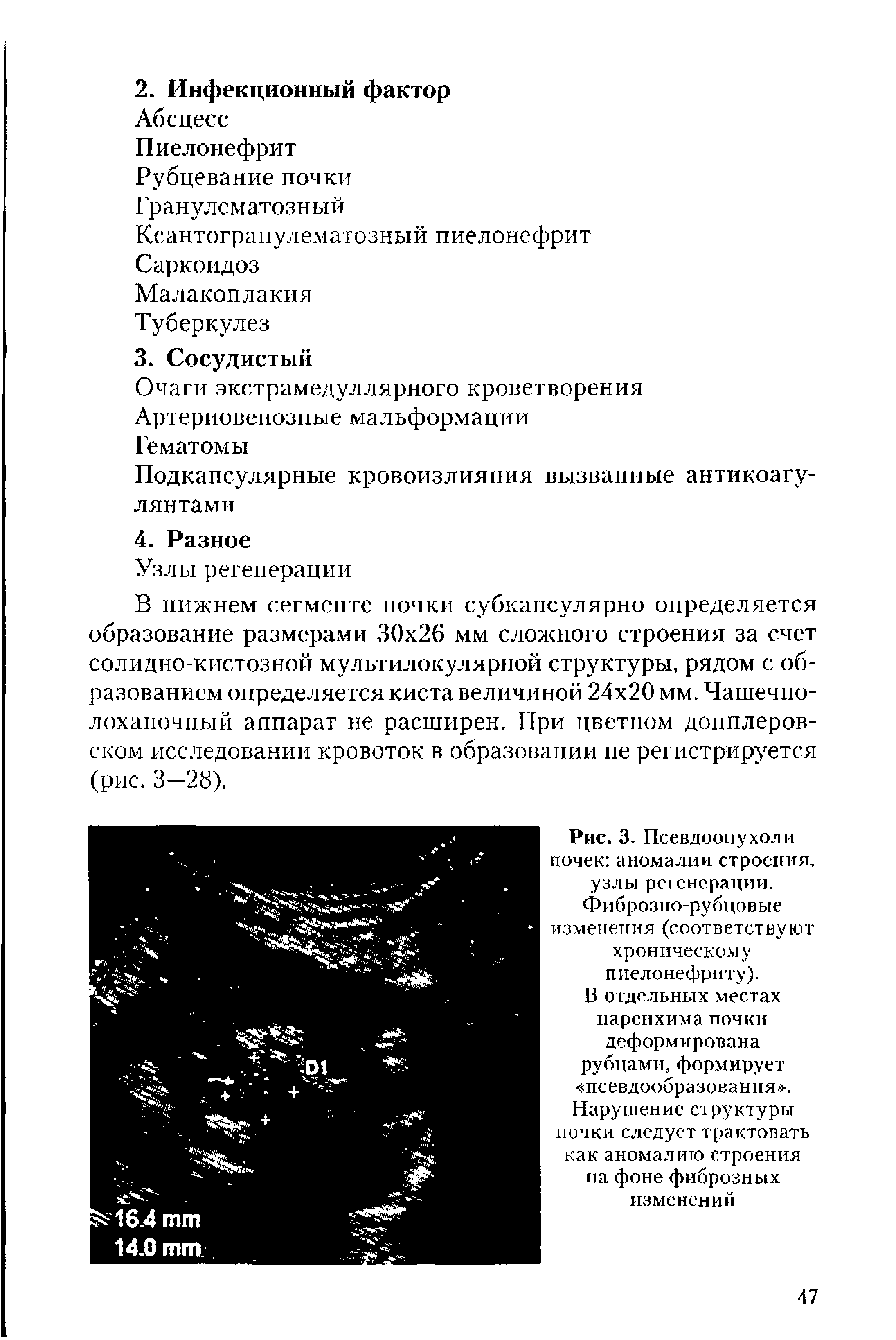 Рис. 3. Псевдоопухоли почек аномалии строения, узлы снсрации. Фиброзпо-рубцовые изменения (соответствуют хроническому пиелонефриту).