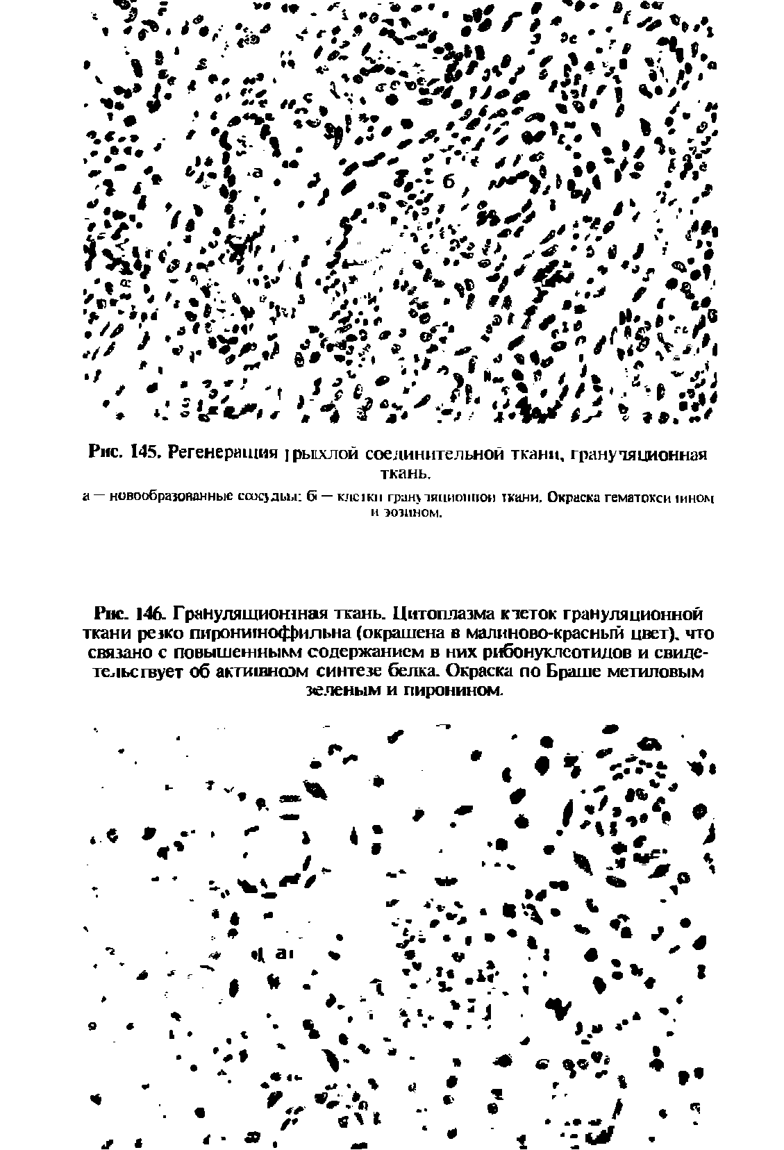 Рис. 146. Грануляшионзная ткань. Цитоплазма к теток грануляционной ткани резко пироншнофЬильна (окрашена в малиново-красный цвет), что связано с повышензныкм содержанием в них рибонуклеотидов и свидетельствует об актизвноэм синтезе белка. Окраска по Браше метиловым зеленым и пиронином.