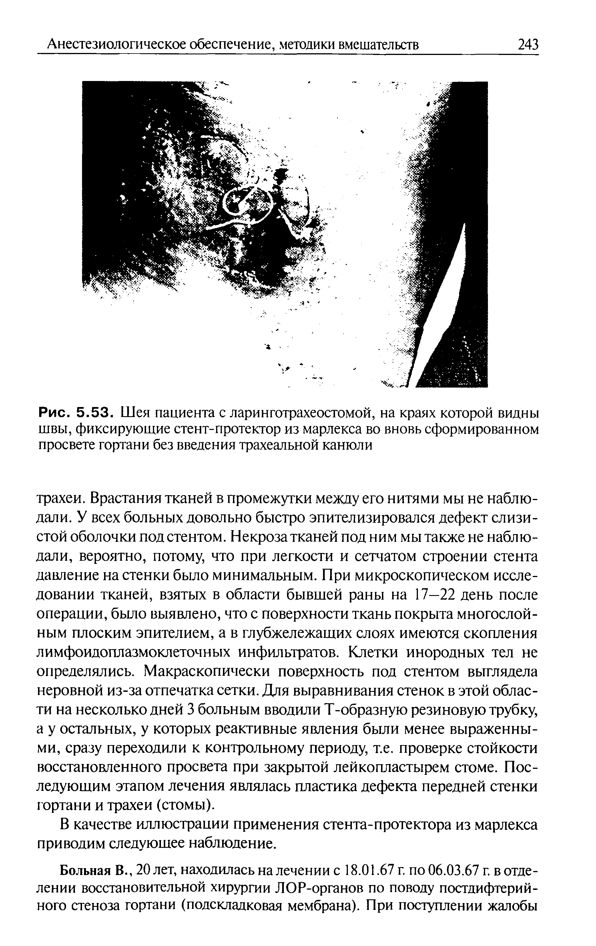 Рис. 5.53. Шея пациента с ларинготрахеостомой, на краях которой видны швы, фиксирующие стент-протектор из марлекса во вновь сформированном просвете гортани без введения трахеальной канюли...