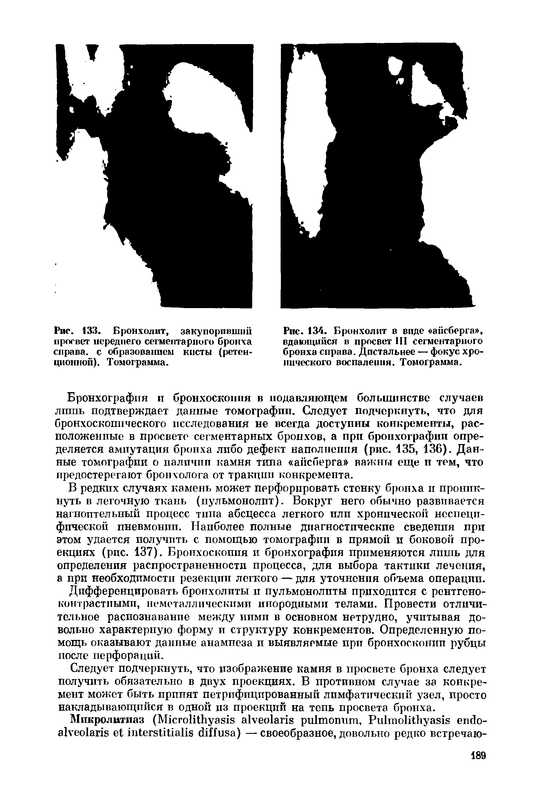 Рис. 134. Бронхолит в виде айсберга , вдающийся в просвет III сегментарного бронха справа. Дистальнее — фокус хронического воспаления. Томограмма.