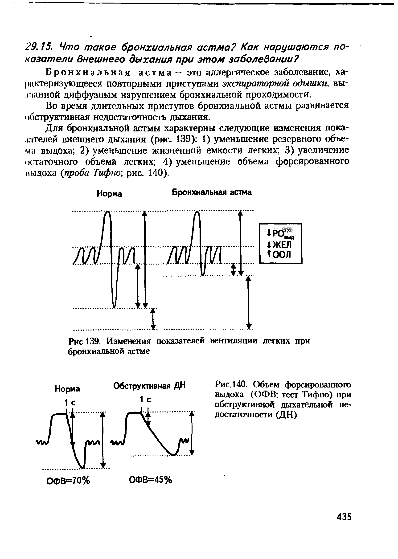 Рис. 140. Объем форсированного выдоха (ОФВ тест Тифно) при обструктивной дыхательной недостаточности (ДН)...