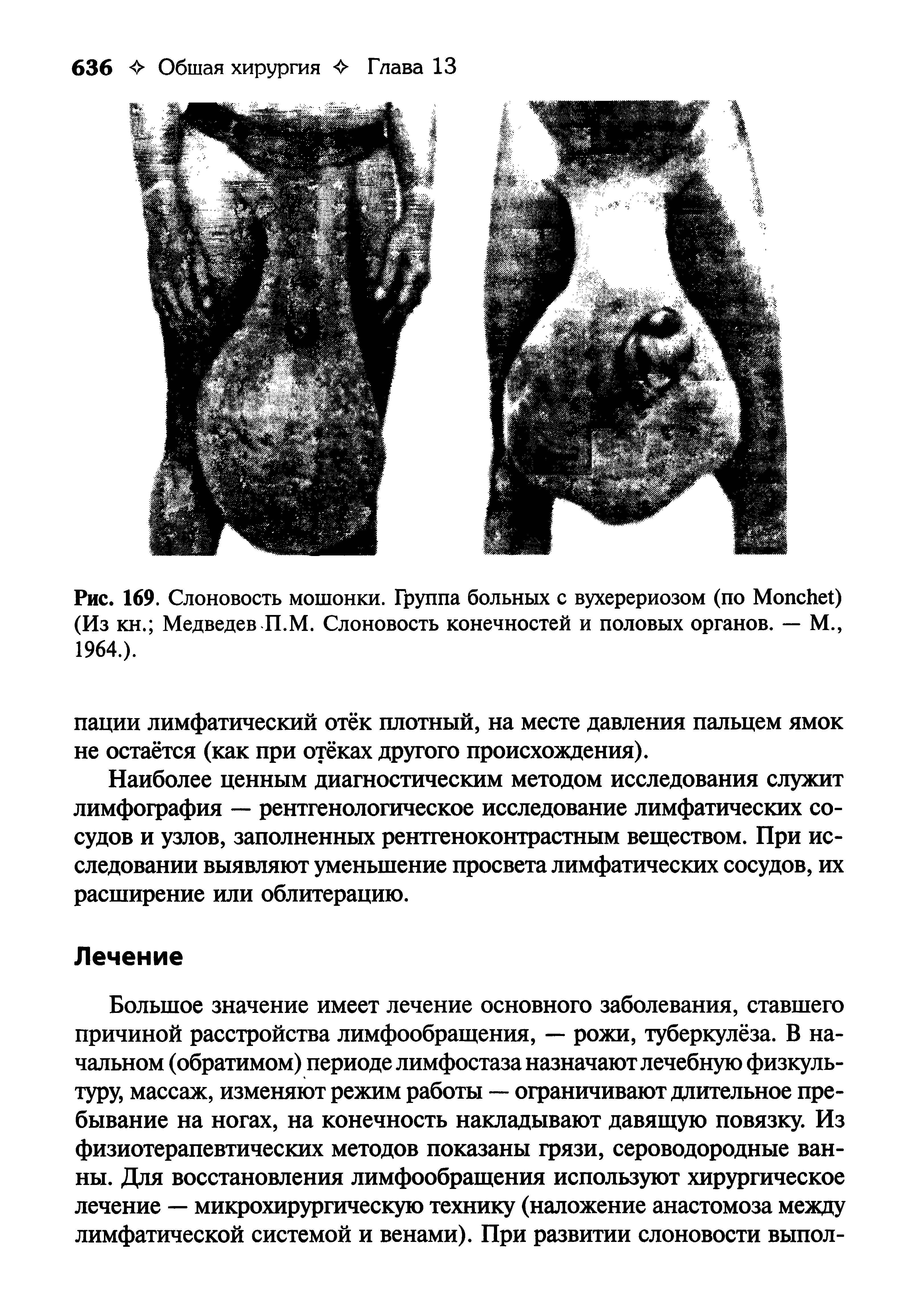 Рис. 169. Слоновость мошонки. Группа больных с вухерериозом (по МопсЬеО (Из кн. Медведев П.М. Слоновость конечностей и половых органов. — М., 1964.).