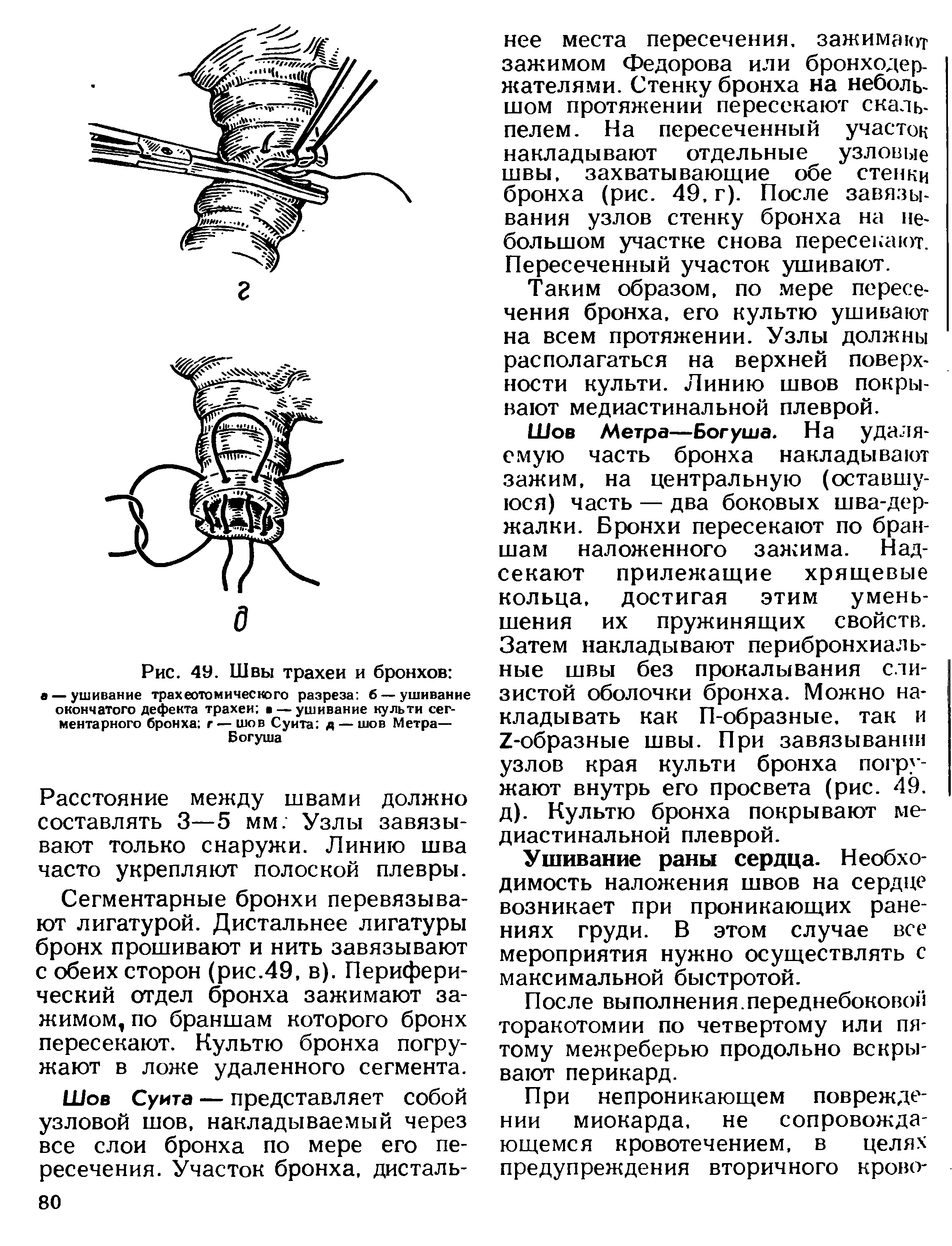 Рис. 4У. Швы трахеи и бронхов а — ушивание трахеотомического разреза б — ушивание окончатого дефекта трахеи в — ушивание культи сегментарного бронха г — шов Суита д — шов Метра— Богуша...