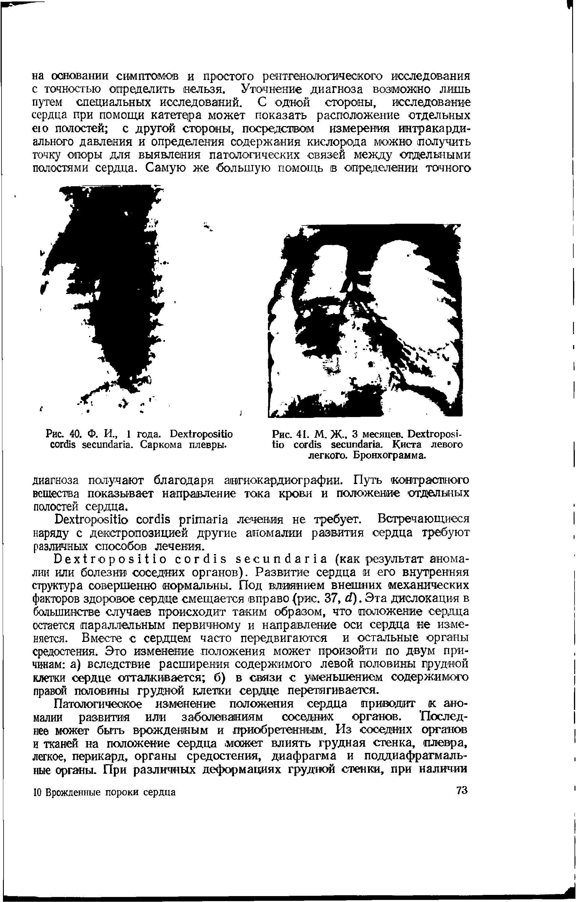 Рис. 40. Ф. И., 1 года. D . Саркома плевры.