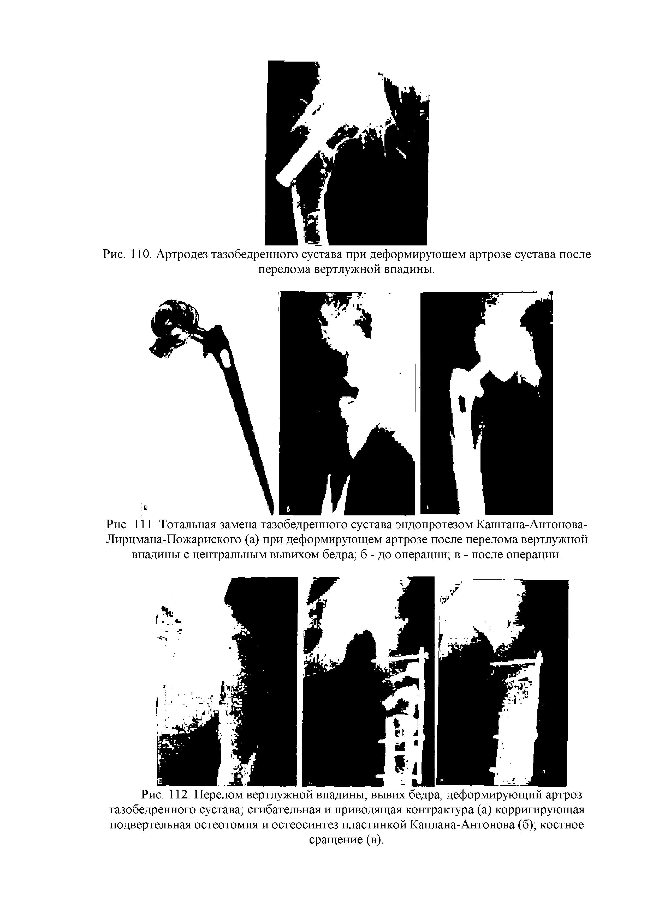 Рис. 111. Тотальная замена тазобедренного сустава эндопротезом Каштана-Антонова-Лирцмана-Пожариского (а) при деформирующем артрозе после перелома вертлужной впадины с центральным вывихом бедра б - до операции в - после операции.