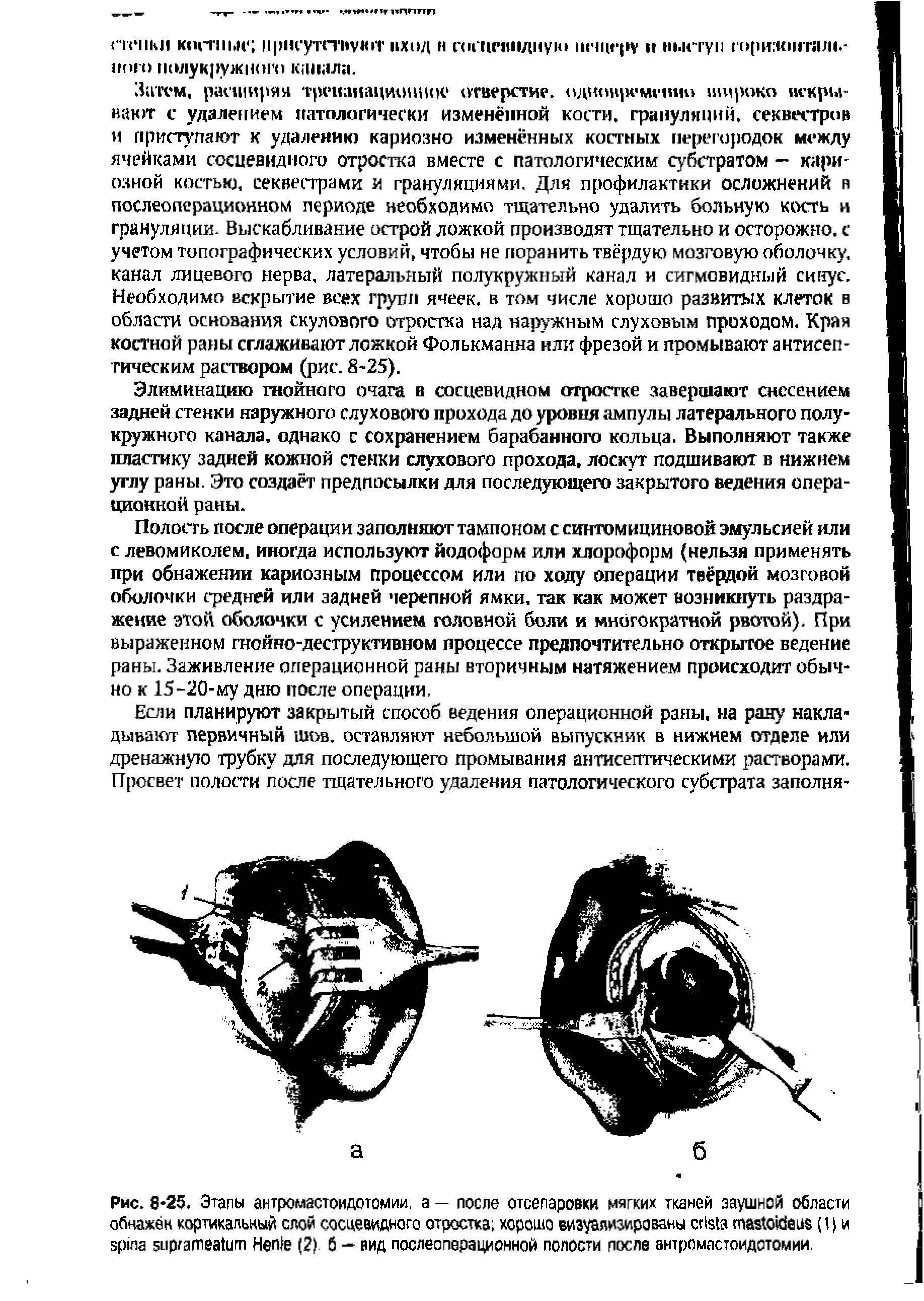 Рис. 8-25. Этапы ан тромастои дотом ии, а — после отсепаровки мягких тканей заушной области обнажён кортикальный слой сосцевидного отростка хорошо визуализированы (I) и H (2) б — вид послеоперационной полости после антромастоидотомии.