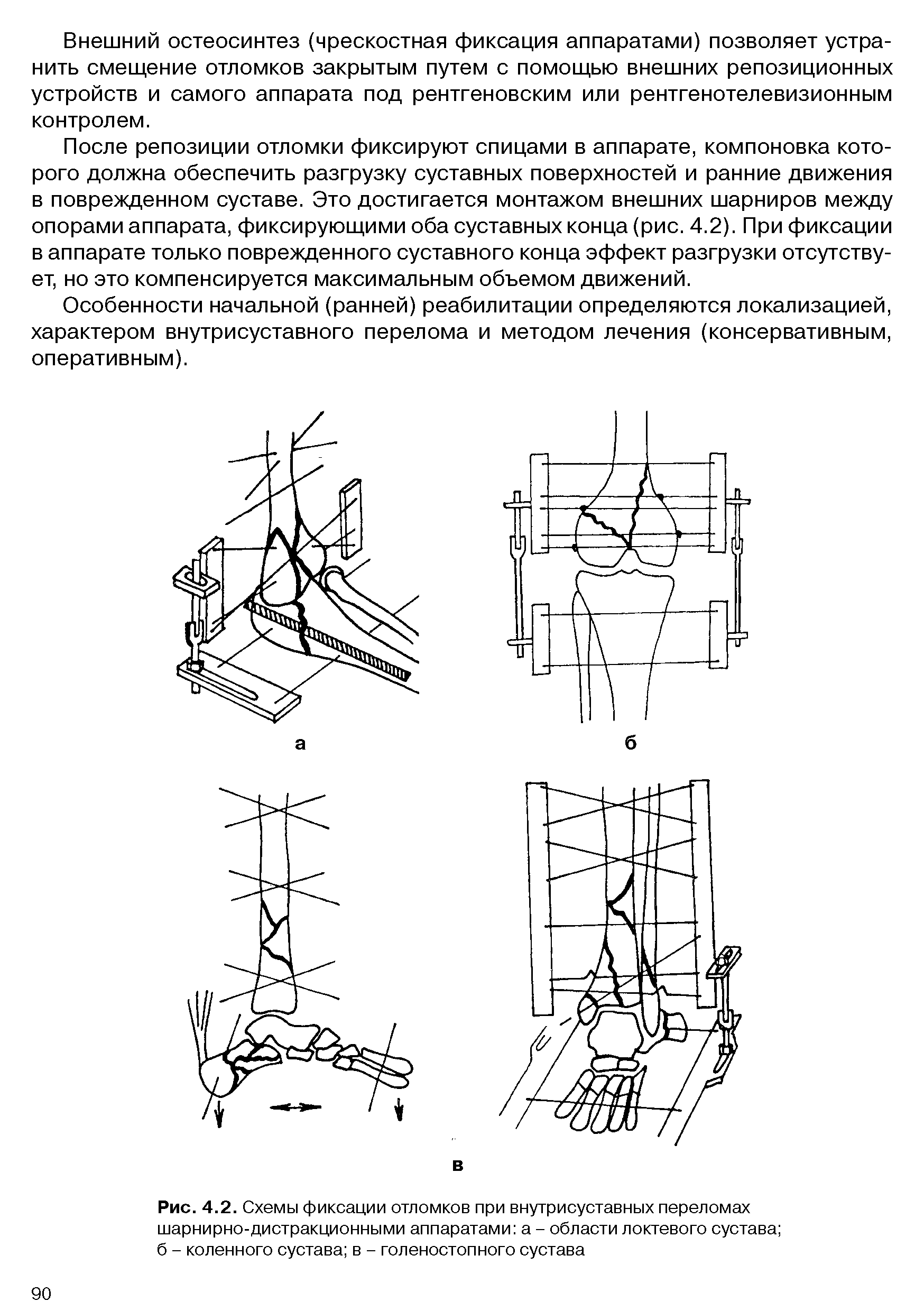 Рис. 4.2. Схемы фиксации отломков при внутрисуставных переломах шарнирно-дистракционными аппаратами а - области локтевого сустава б - коленного сустава в - голеностопного сустава...