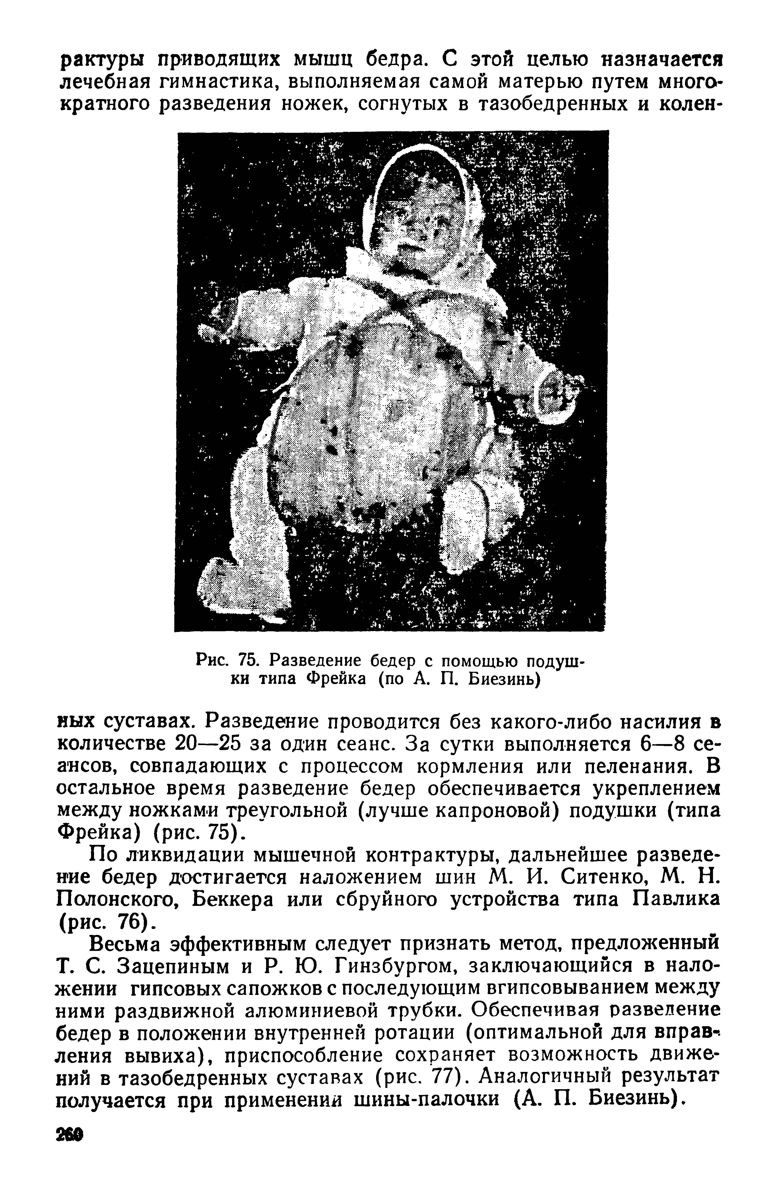 Рис. 75. Разведение бедер с помощью подушки типа Фрейка (по А. П. Биезинь)...