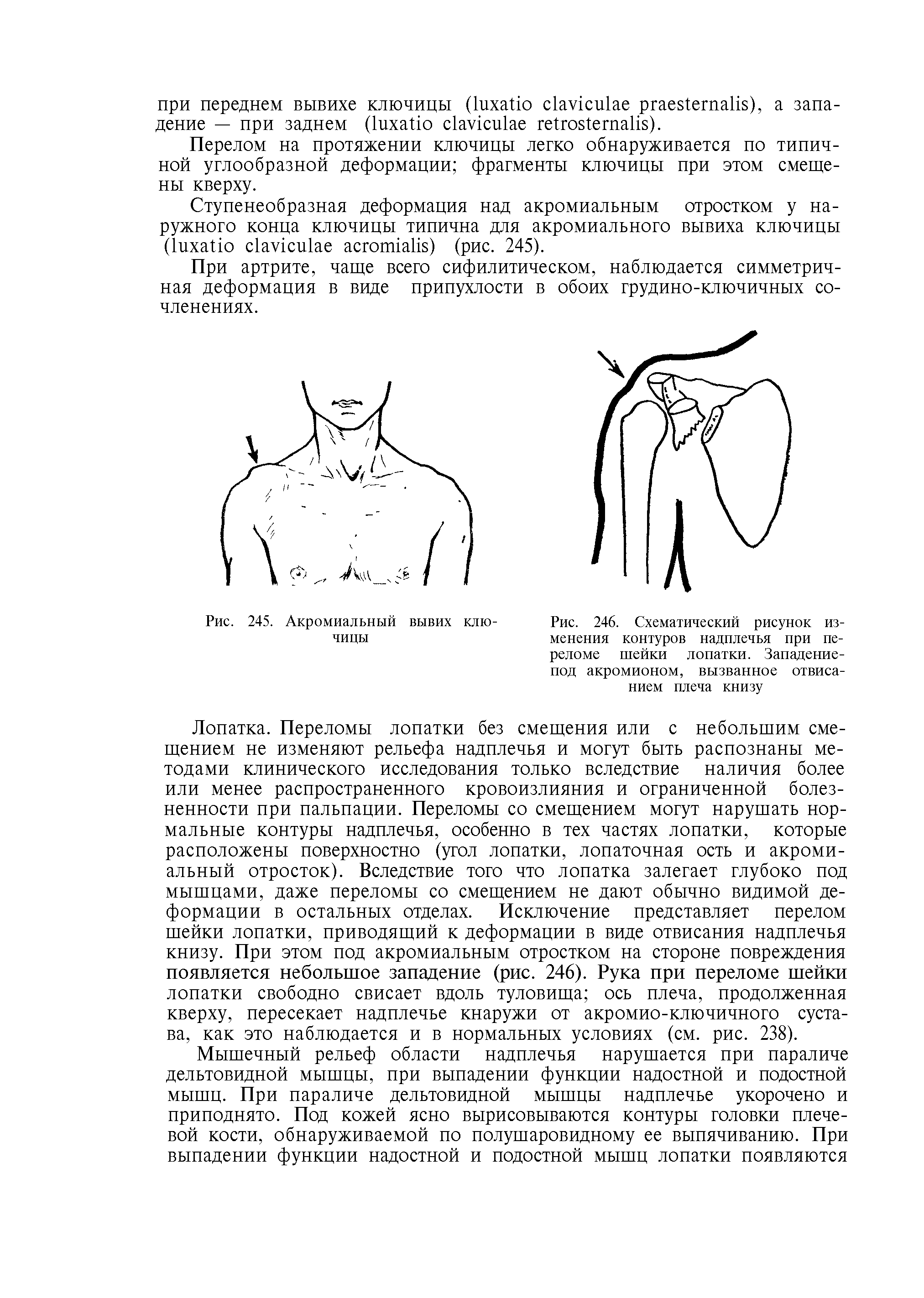 Рис. 246. Схематический рисунок изменения контуров надплечья при переломе шейки лопатки. Западение-под акромионом, вызванное отвисанием плеча книзу...